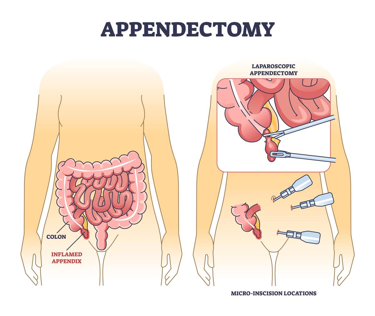 胸腹联合手术 - 了解'thoracoabdominal surgery' 的定义和应用