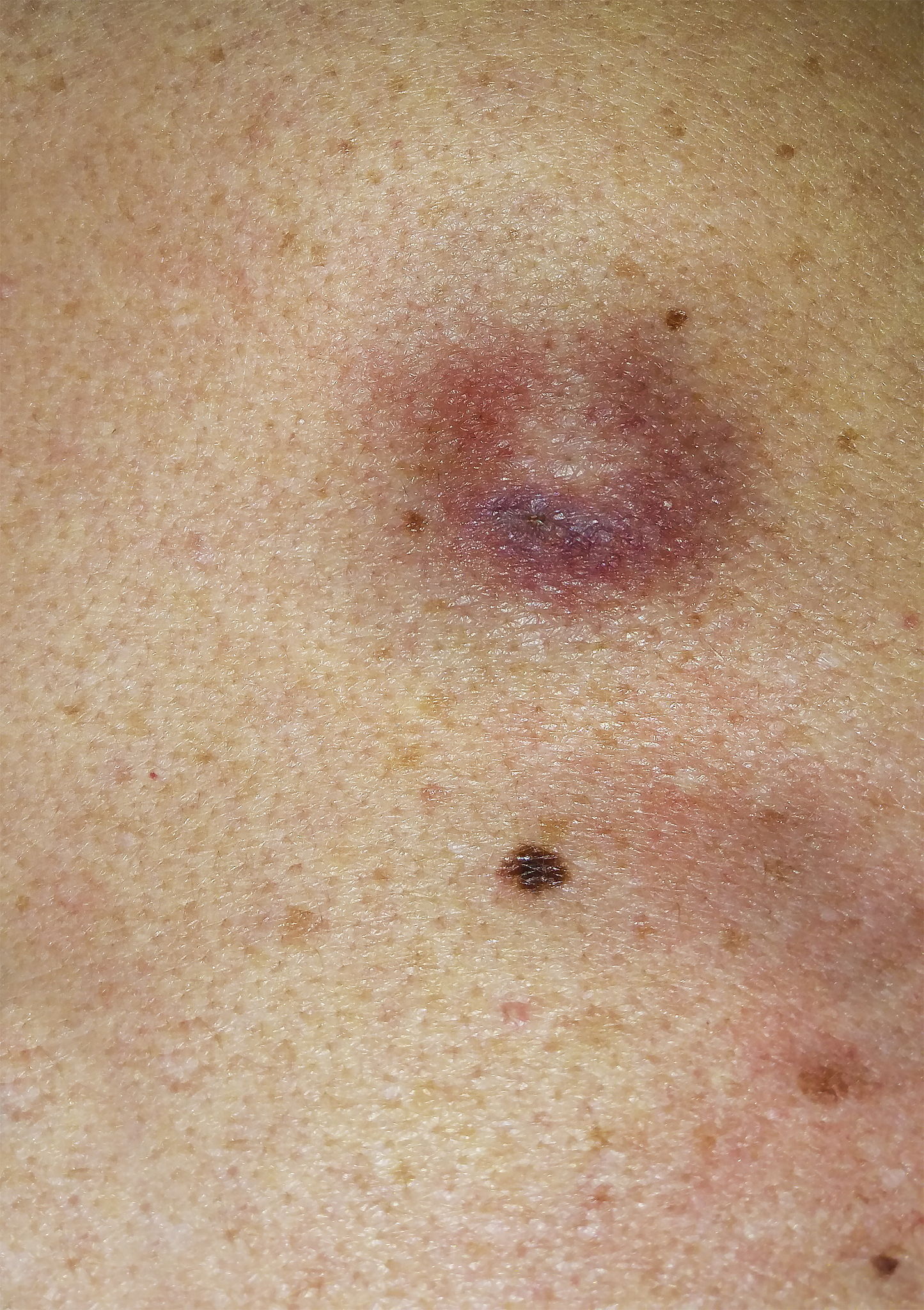 human skin with skin cancer, beauty mark, freckles