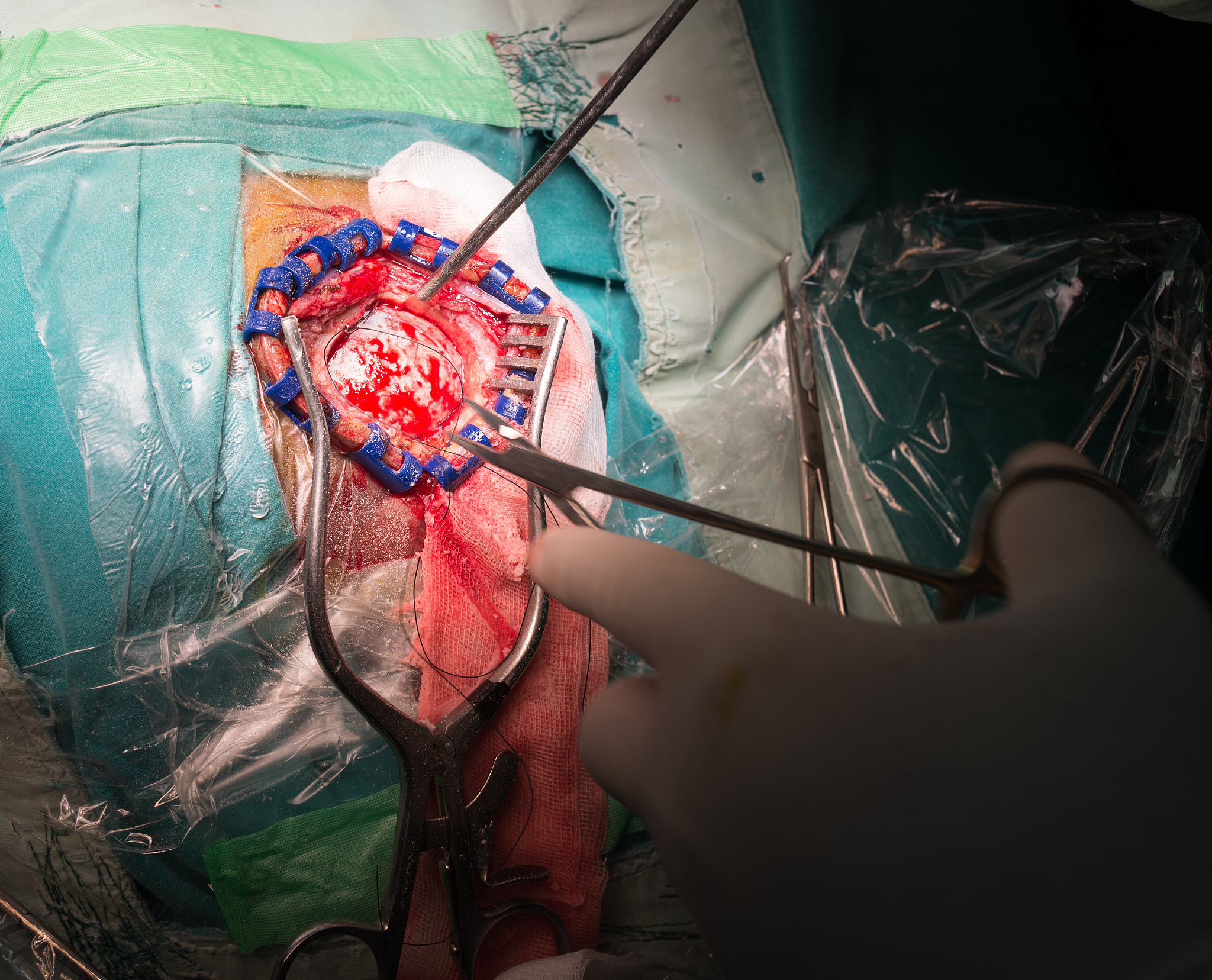 腹股沟疝手术因素深度解析：从手术方式到术后恢复