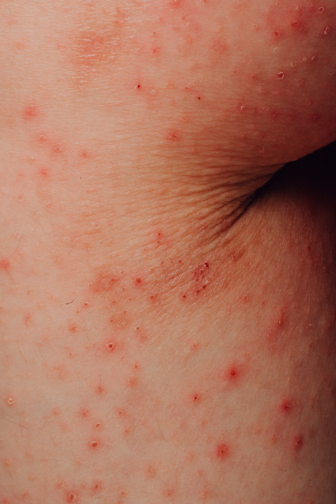 一个月宝宝脸为什么总是起红疹子