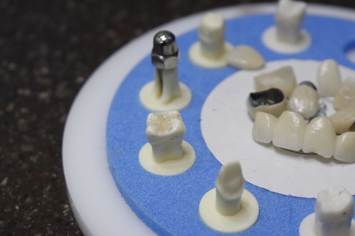 后牙缺失有牙周炎选择士卓曼的软组织水平种植体还是骨水平种植体？