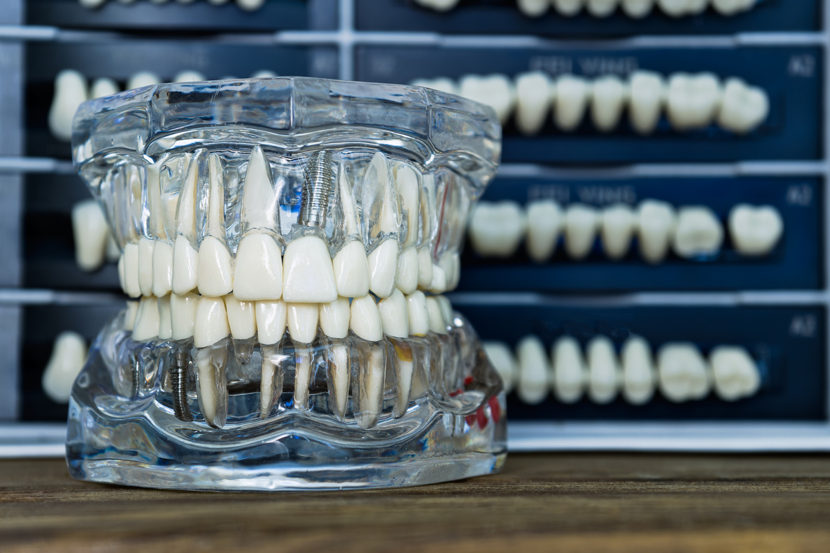 种植牙技术：软组织水平种植体和骨水平种植体比较