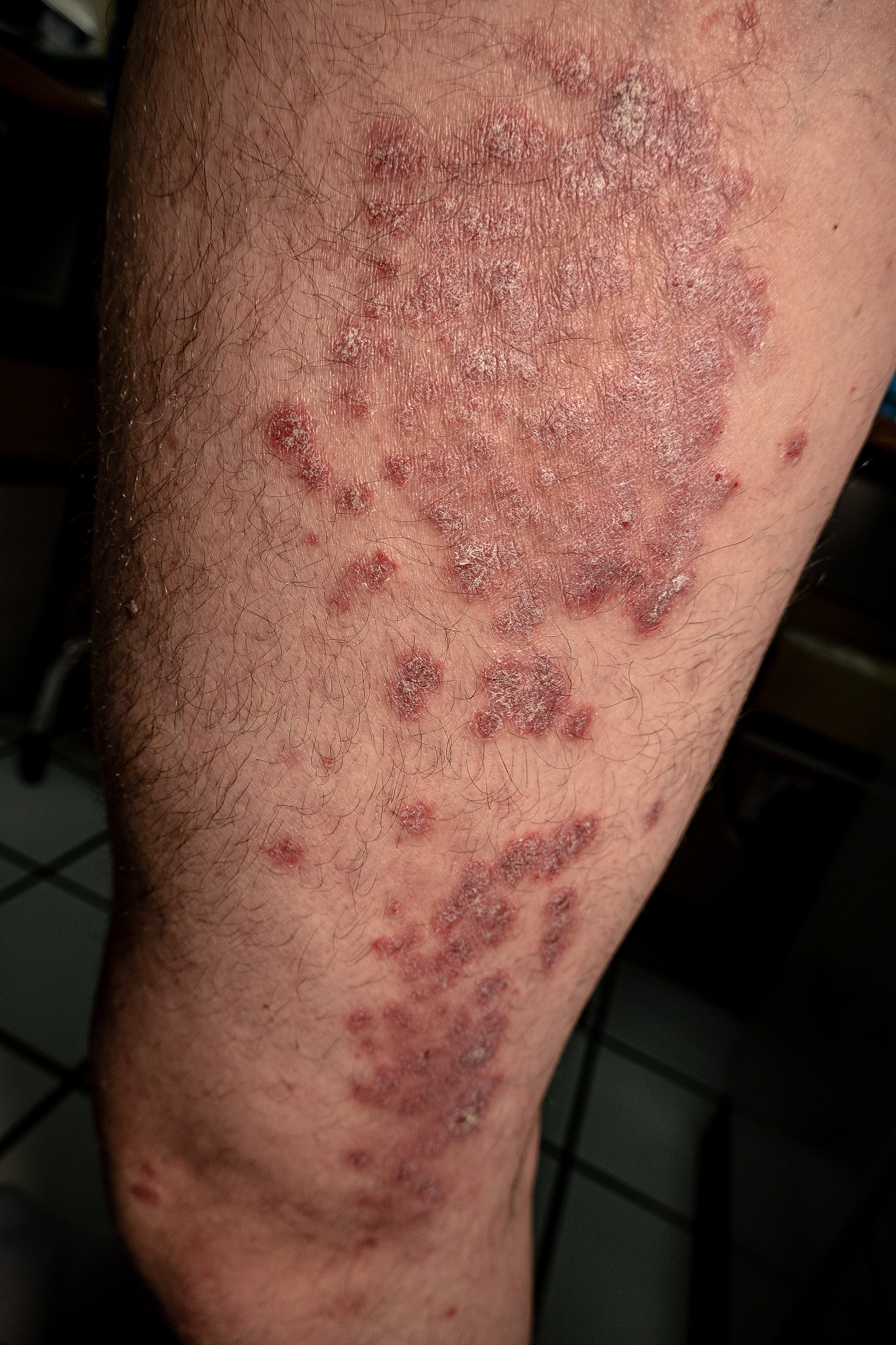 psoriasis is a chronic, inflammatory autoinmune skin disease