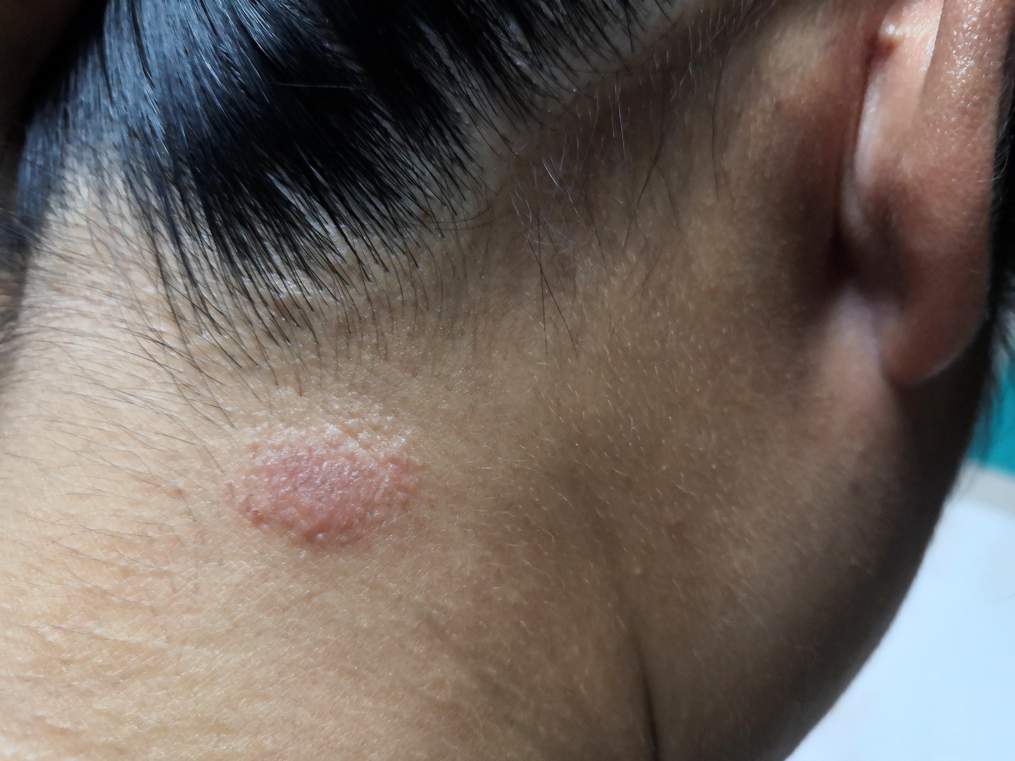 ringworm (tinea) on head of asian woman (dermatitis),ring worm i