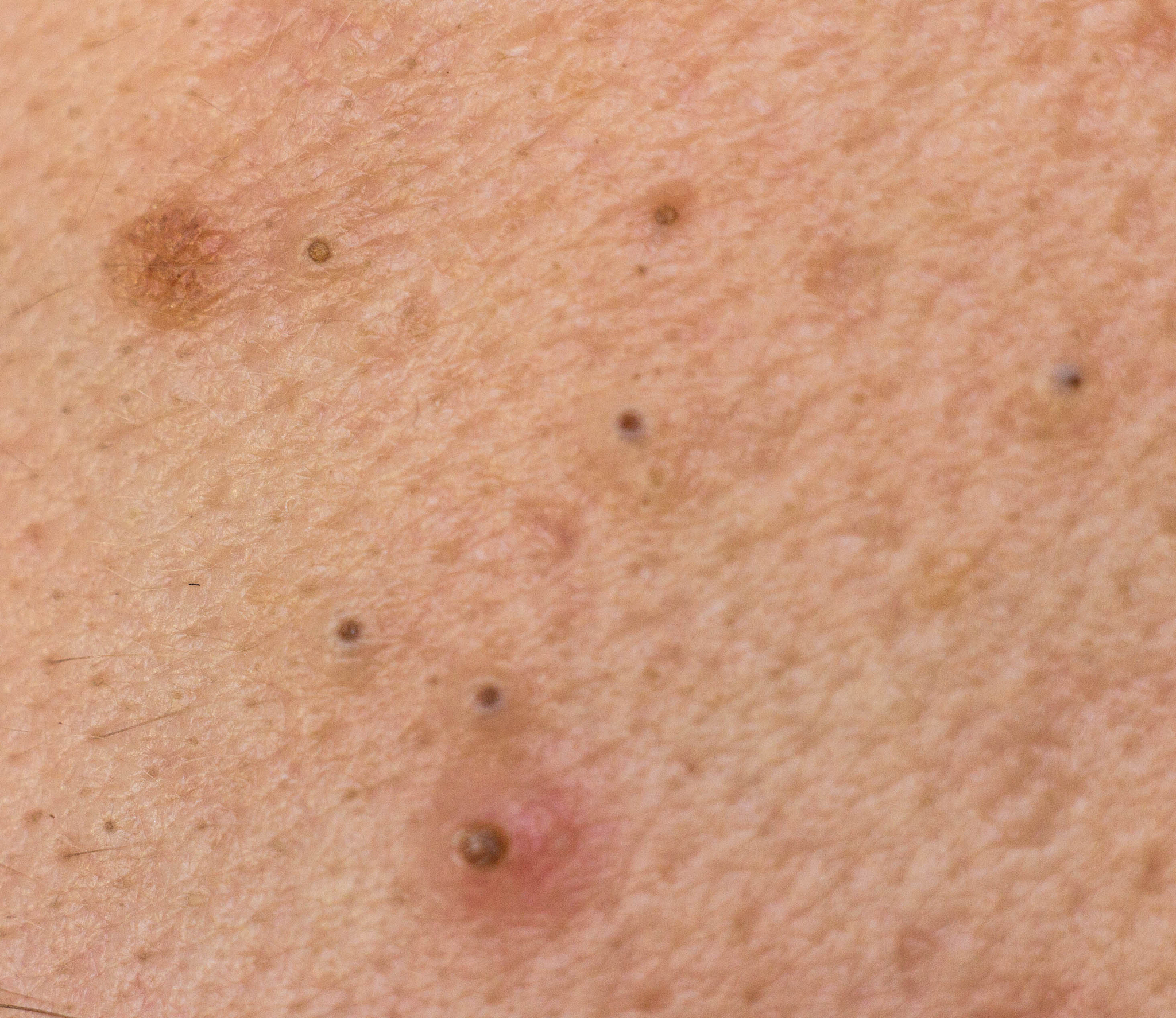 black dots on face and pimples macro, comedo