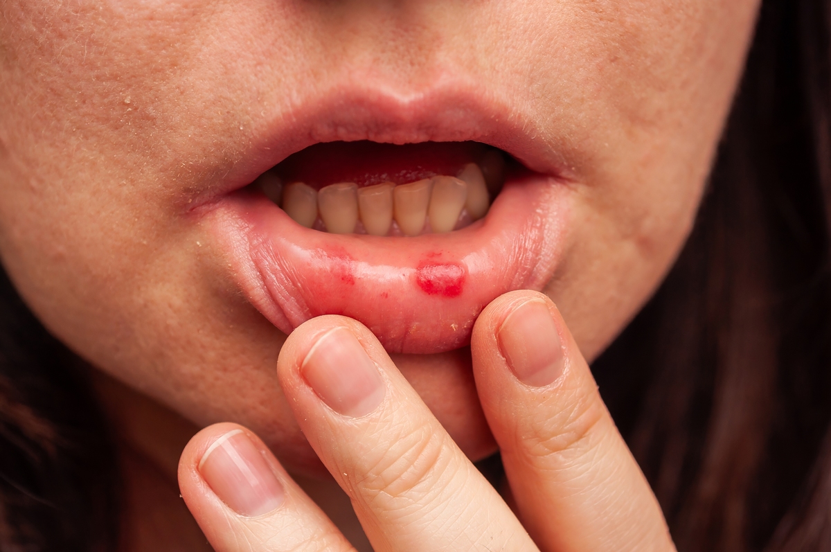 舌头有小红点是艾滋病吗