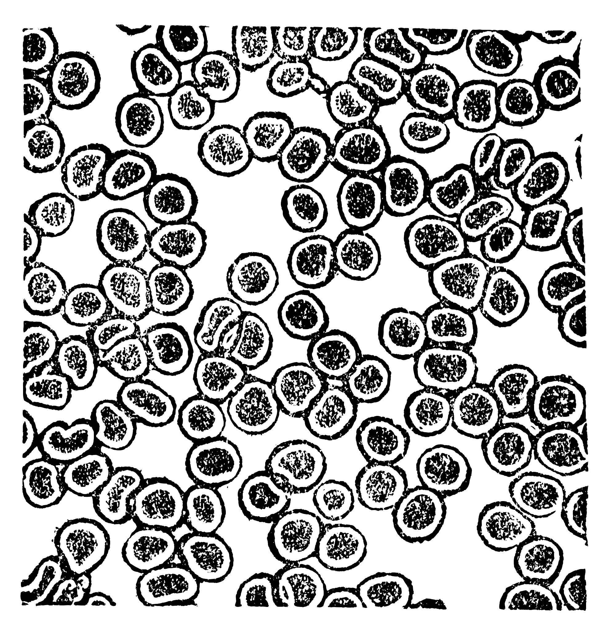 翻译The early post-procedural setting consists of monitoring of theblood pressure haemoglobinhematocrit and maybe urine volume during 24 hours With few exceptions intensive care is notnecessary In gene