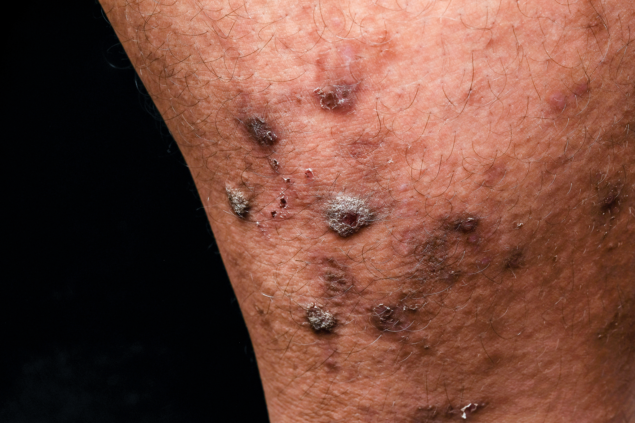closeup dermatitis detail