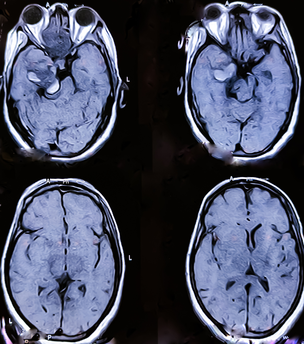 大脑中动脉闭塞症状及差异：学习材料及问答