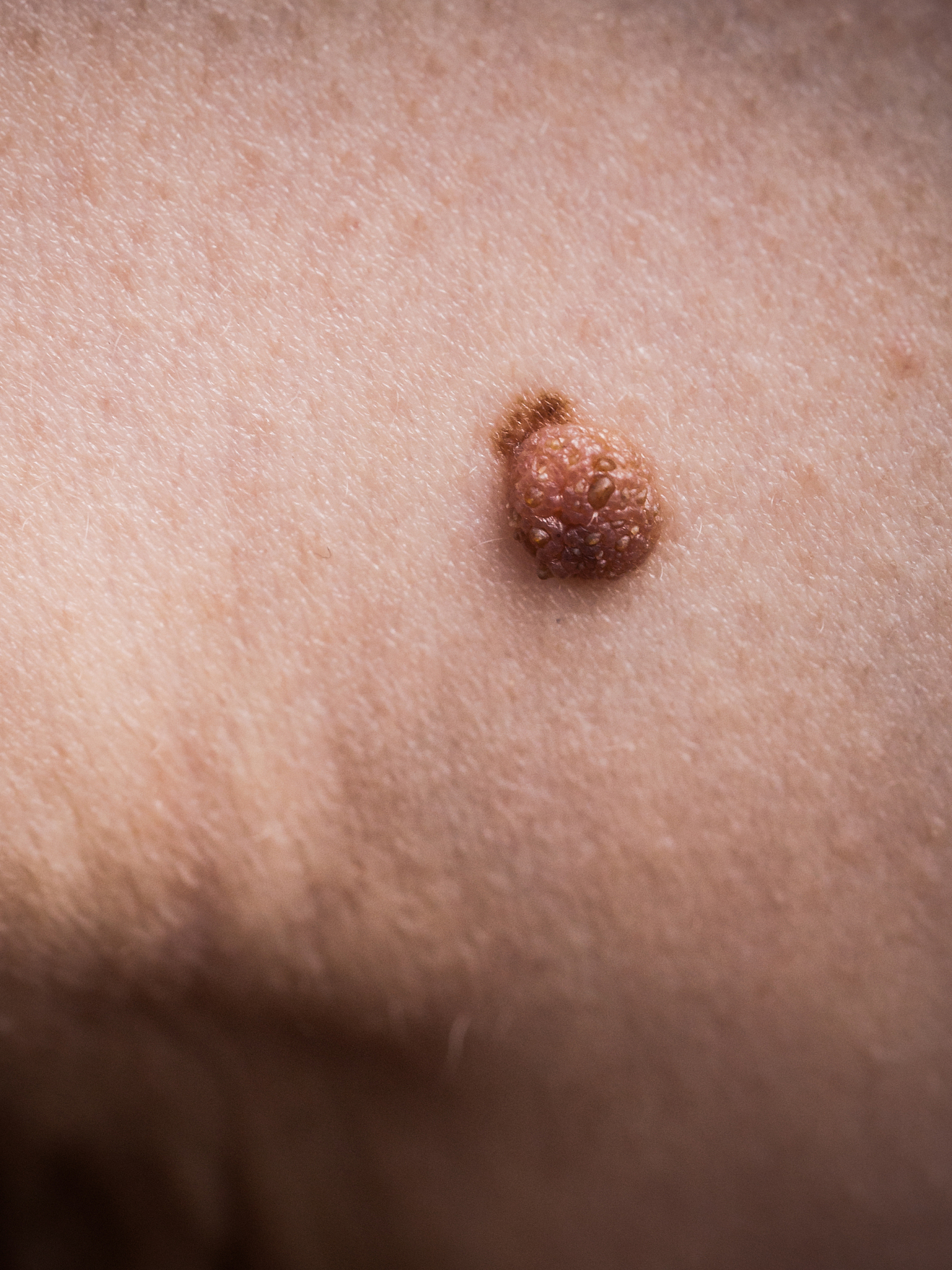 dark fibroma on skin.