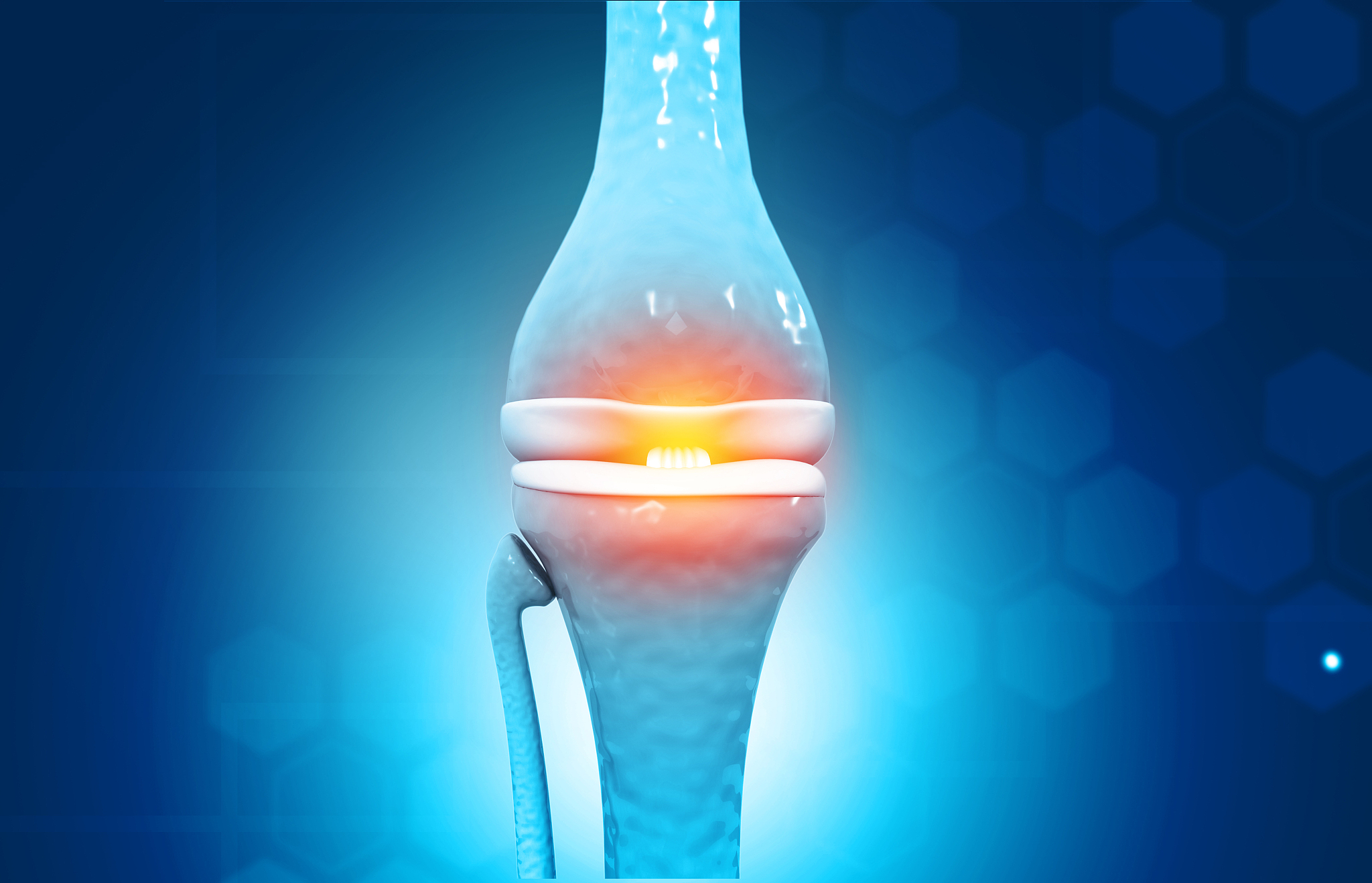 个性化治疗算法：改善膝关节骨关节炎患者长期疗效的利器