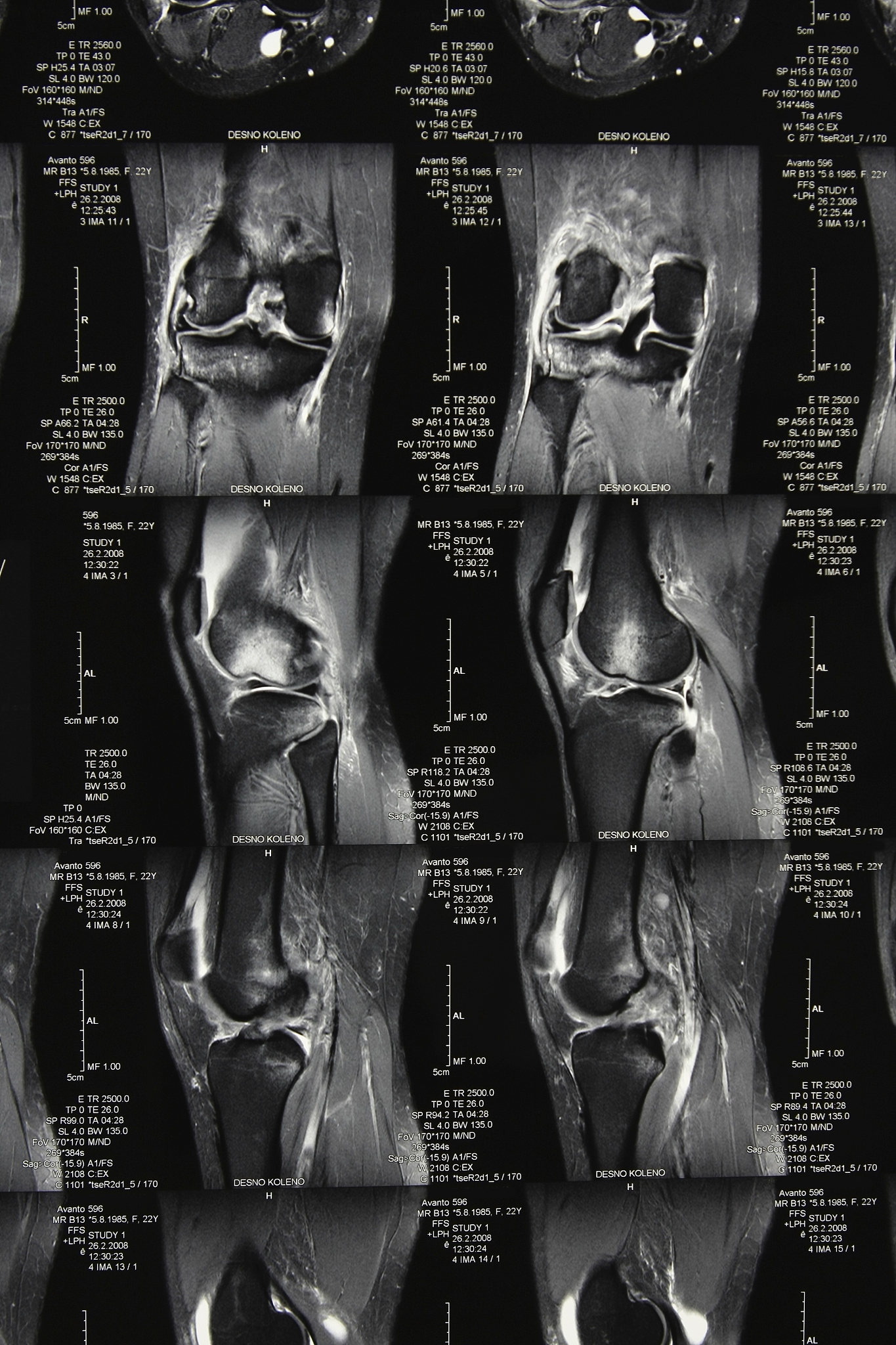 踝关节外侧副韧带损伤术后 MRI 评分：评估恢复情况