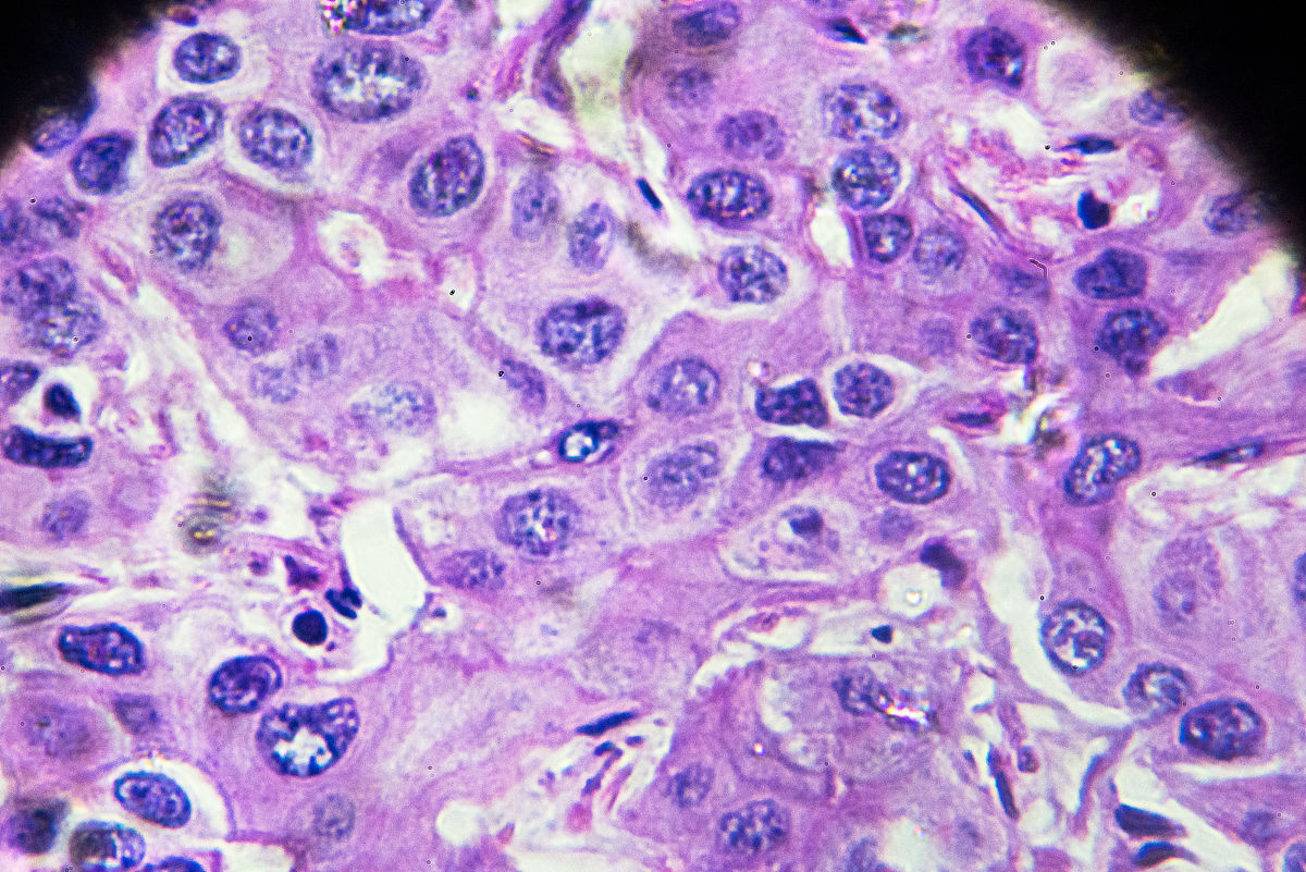 利用肝癌患者和HepG2细胞来源的mrAPs进行诊断或治疗研究