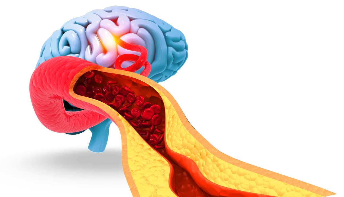 中风相关血栓形成的主要原因：斑块破裂