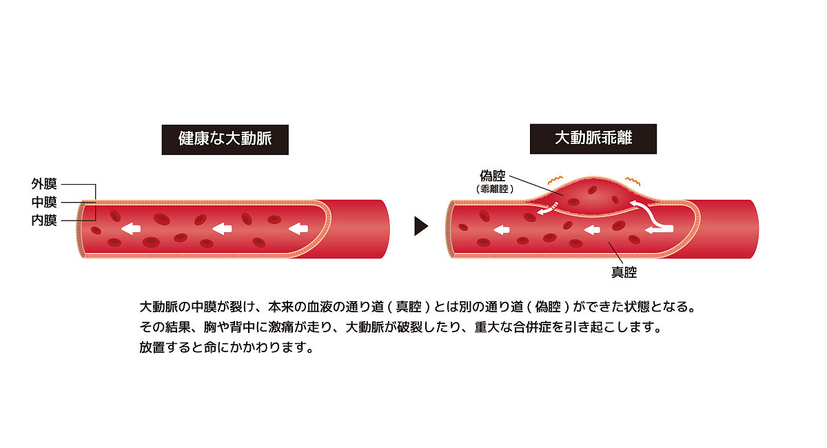 超声显示动脉粥样硬化斑块伴纤维帽断裂及内部出血风险