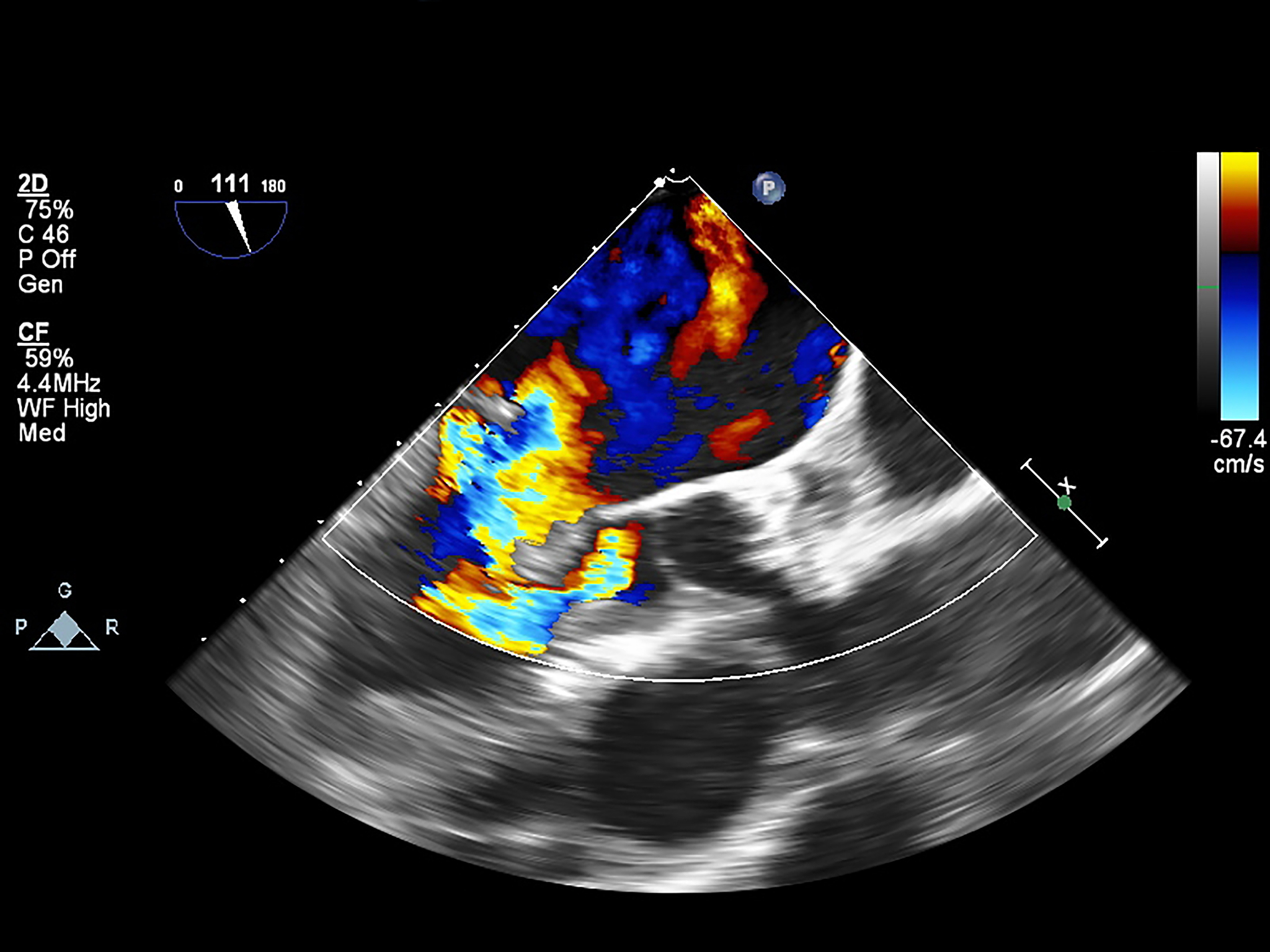 超声造影评估新生血管生成与巨噬细胞浸润的相关性