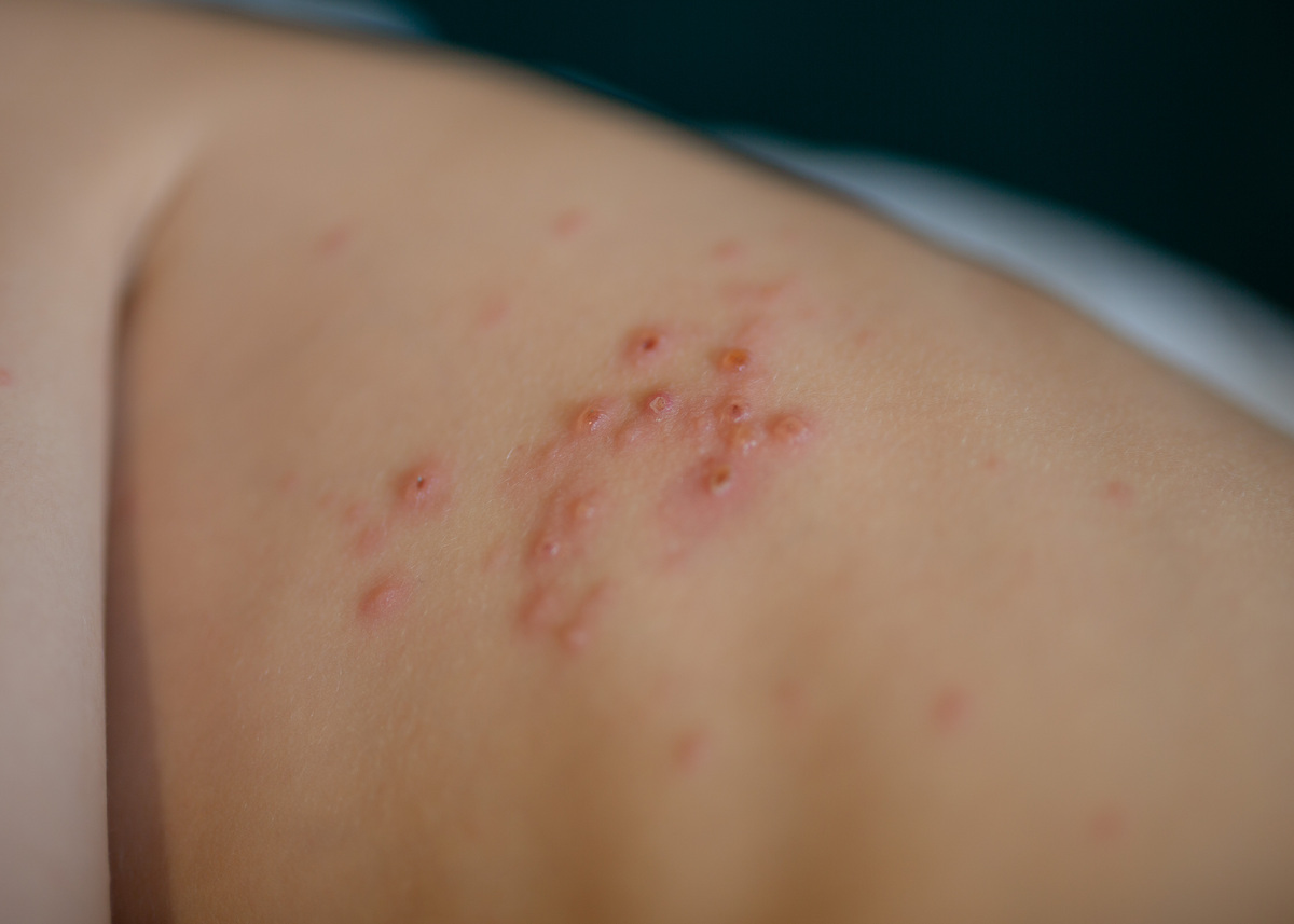 身上起很多疙瘩很痒越来越多怎么回事儿