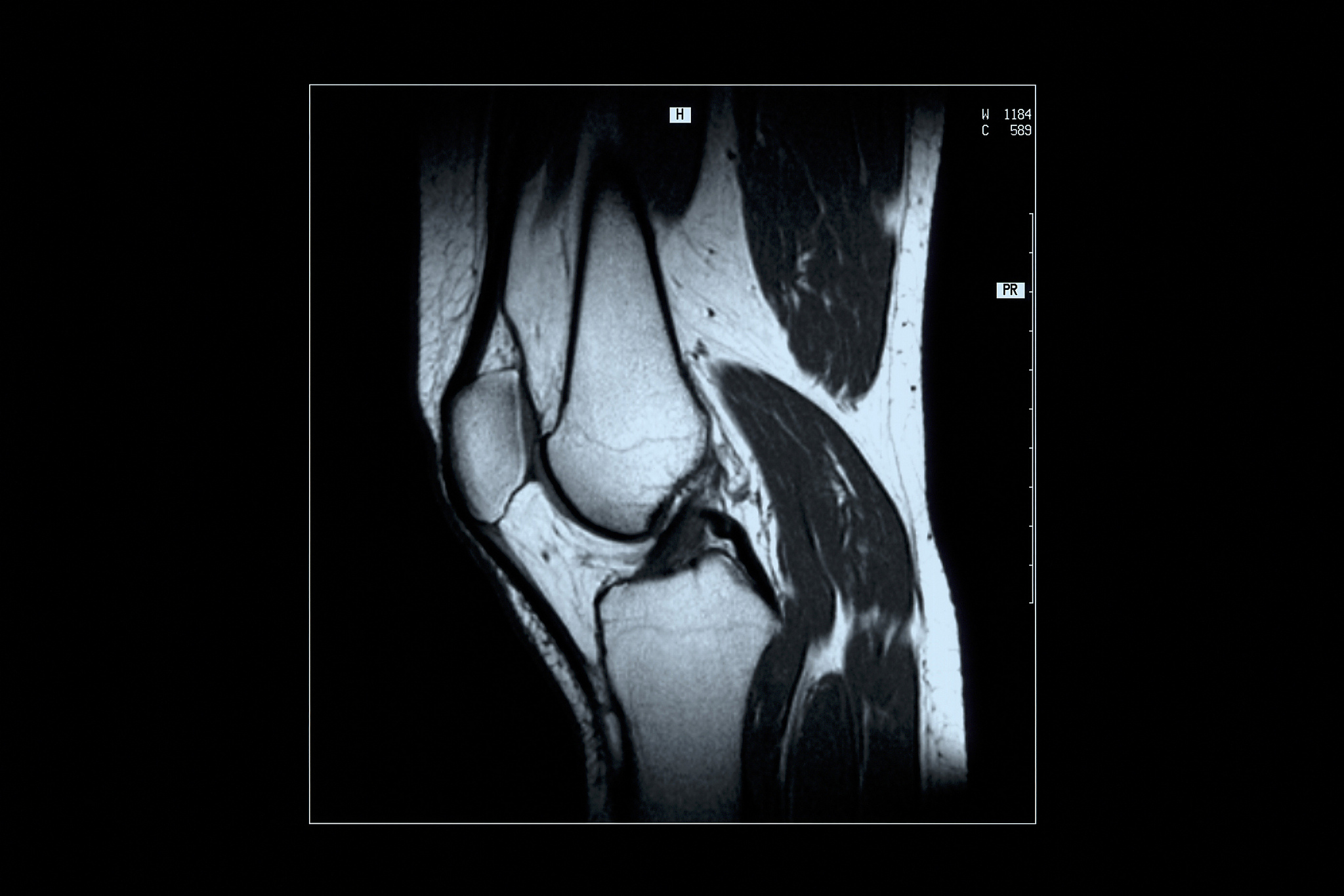 股骨颈骨折患者并骨盆骨折行全髋关节置换手术