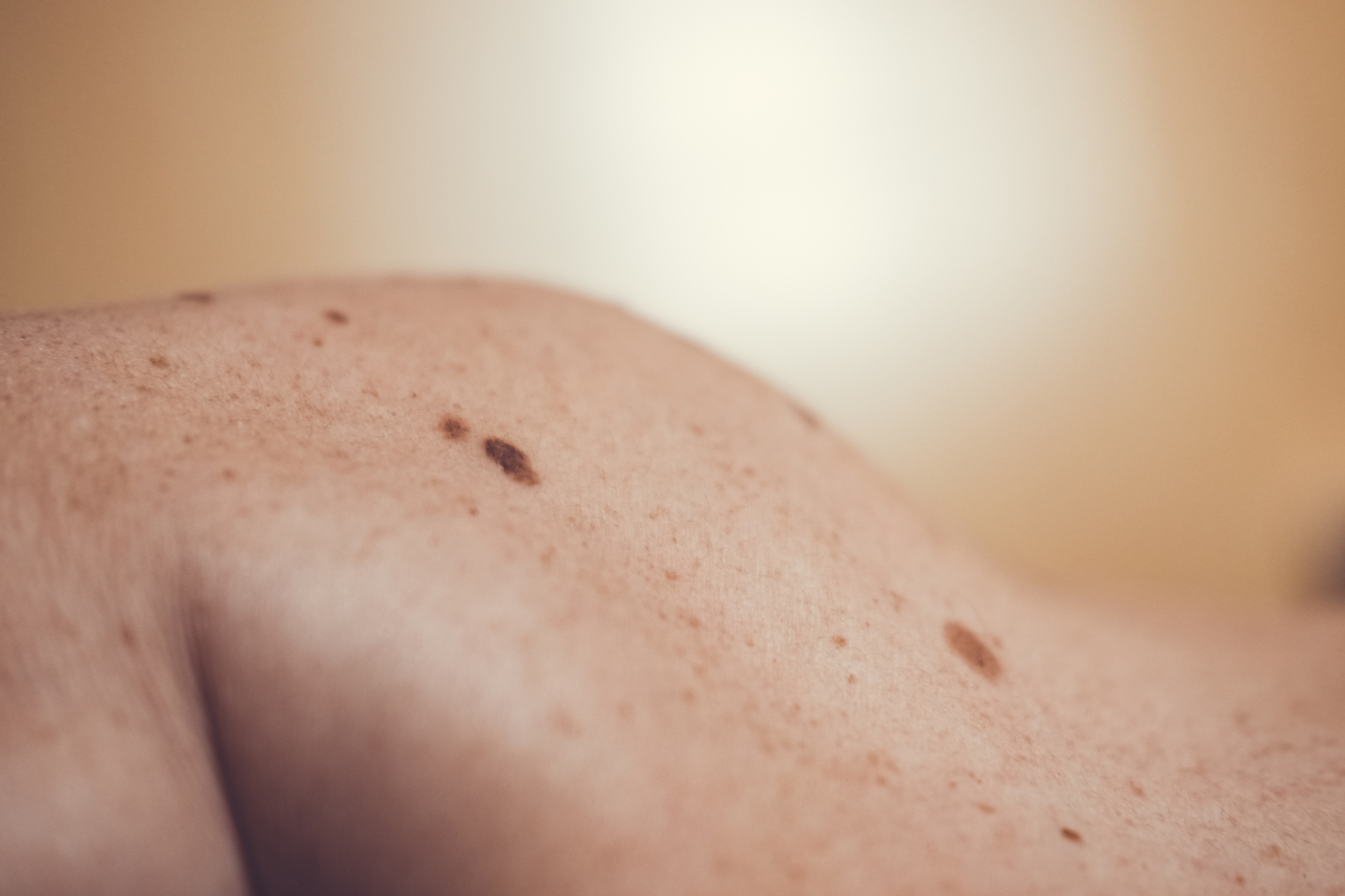 melanocytic nevus, some of them dyplastic or atypical, on a cauc
