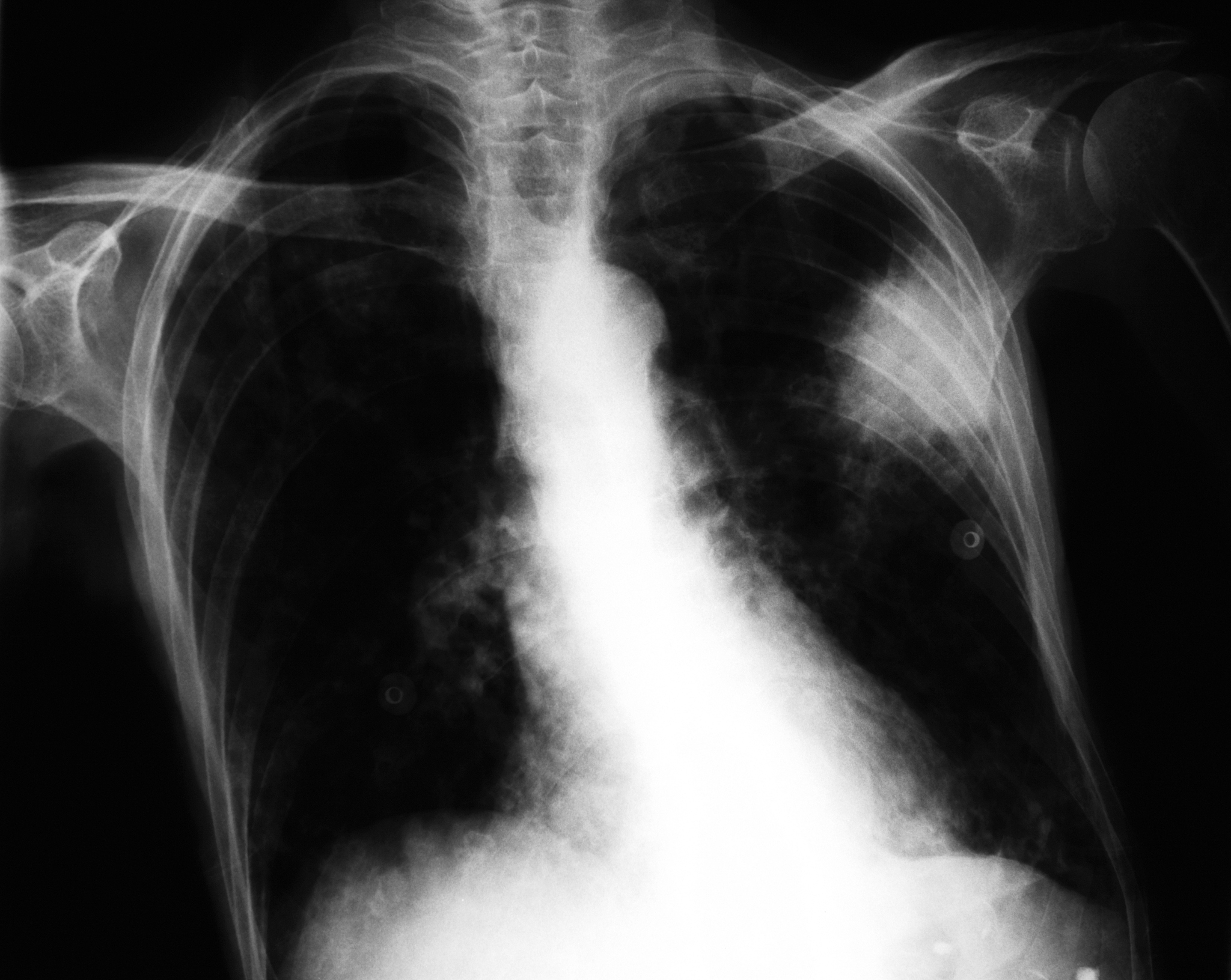 肺癌中晚期影像学表现：X线、CT、MRI 检查揭示病变