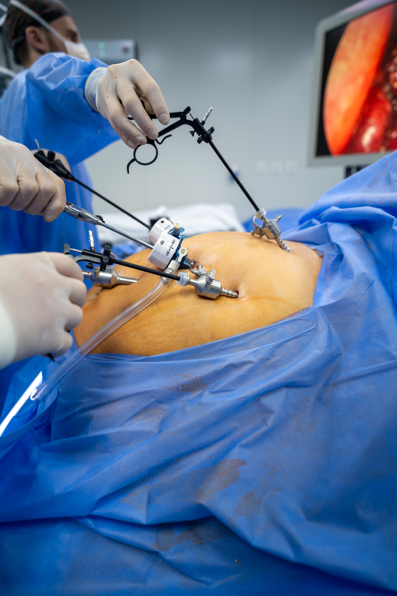 腹部脂肪环吸：告别赘肉，拥有迷人小蛮腰！