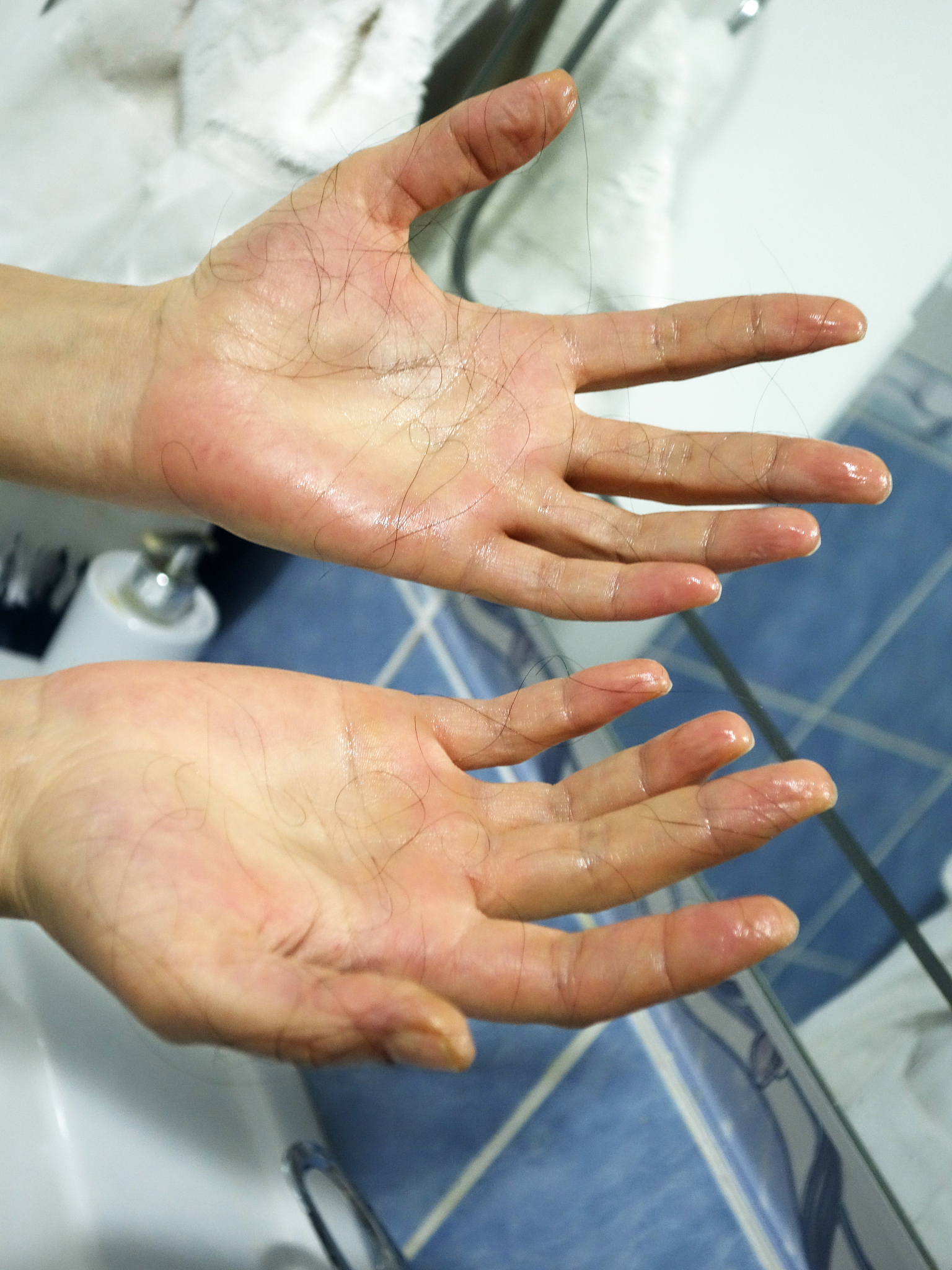 手汗手汗指手部多汗症是一种影响生活质量的常见疾病。手汗可能会导致手掌湿滑、滴水、手握物体不稳定并且会增加感染和皮肤问题的风险。手汗的治疗可通过使用药物、手术或其他治疗方法来缓解症状。同时日常饮食调理和保持良好的习惯也可以对手汗治疗有所帮助。帮我写一份鼓励的话类似这种徐徐微风为你们助跑声声呐喊点燃运动的火焰。随着音乐的的鼓点奋力向前跑胜利就在前方！加油运动健儿们！