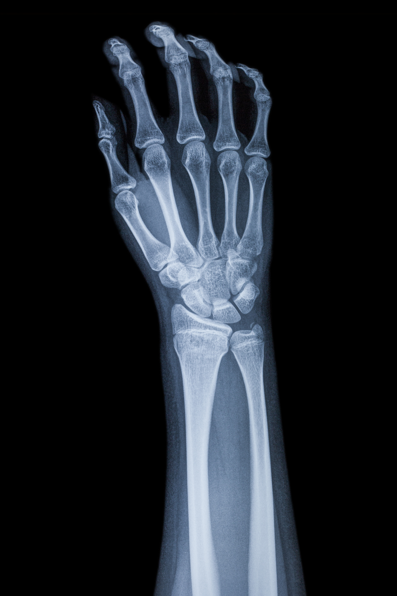 手部骨折：症状、治疗和康复