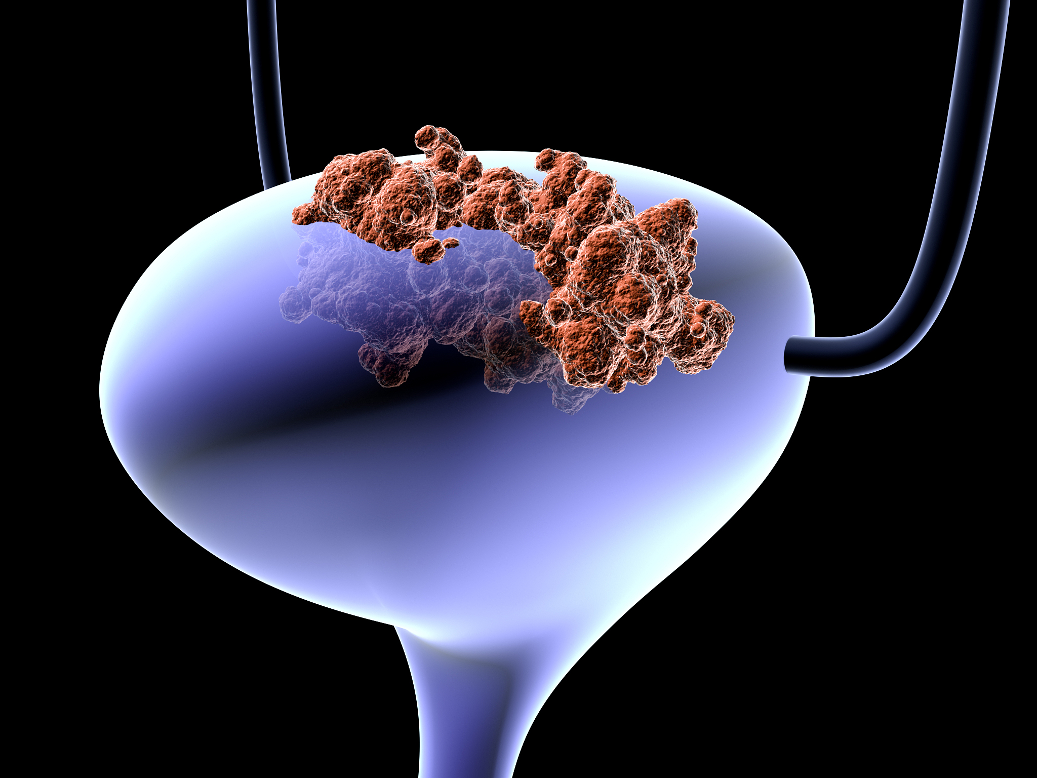 膀胱癌尿路造口术后护理：预防并发症，重拾健康生活