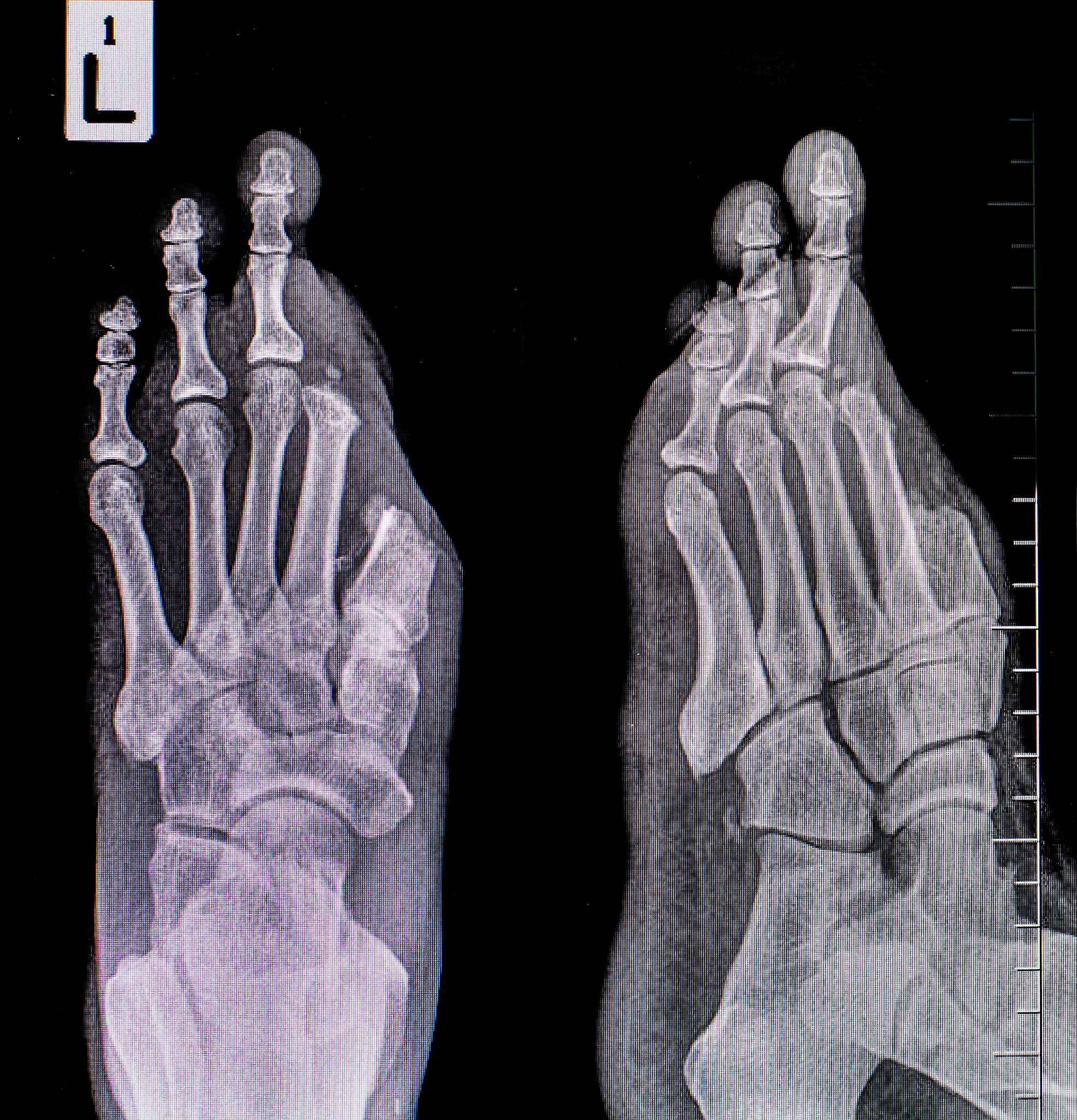 U型前向神经网络：骨龄预测的全新解决方案