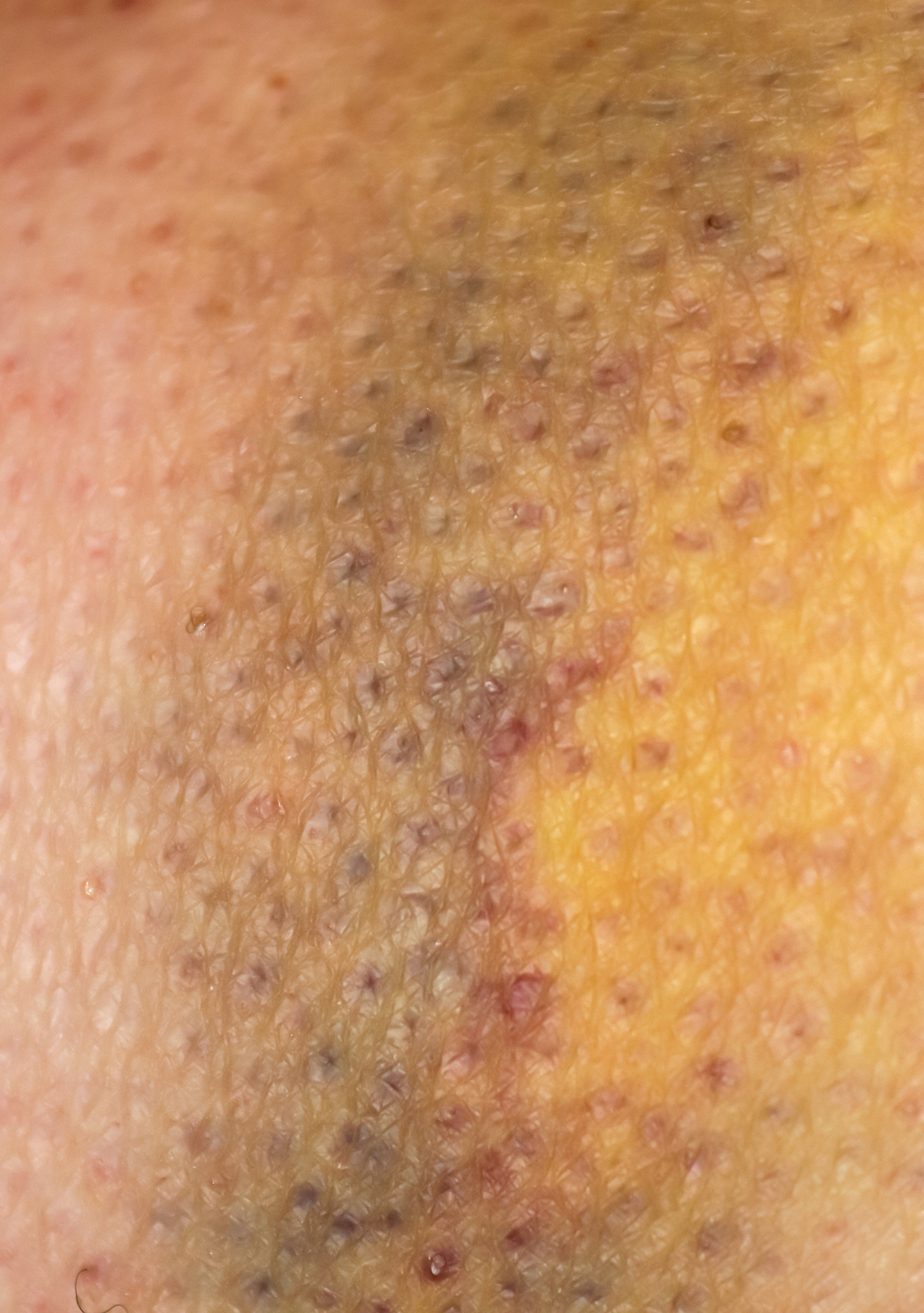 large bruise hematoma on the humans leg on the skin in different