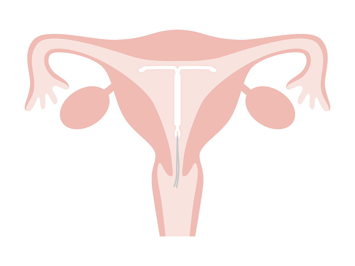 如何预防和治疗子宫肌瘤