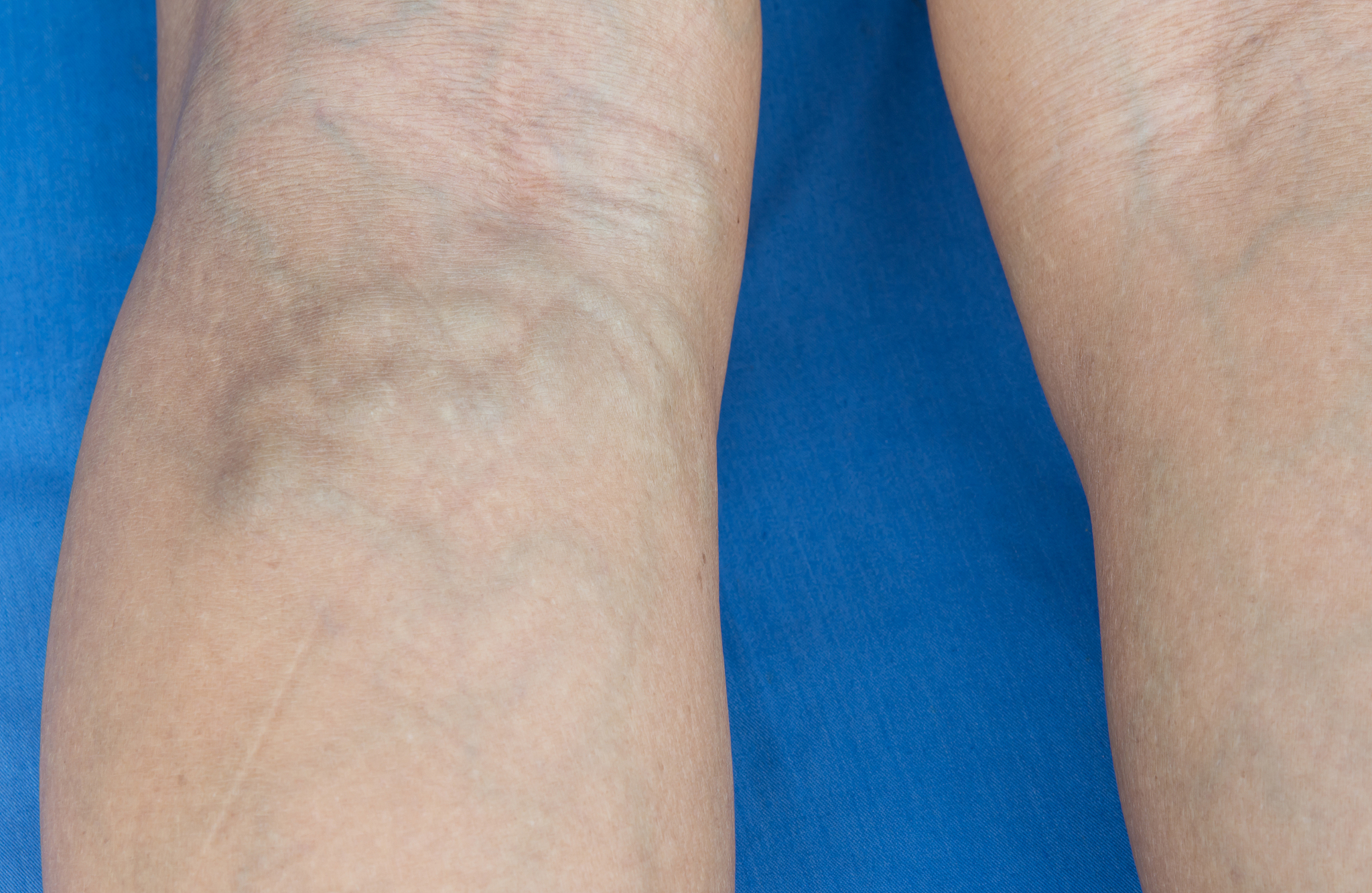 静脉曲张：症状、原因、预防和治疗