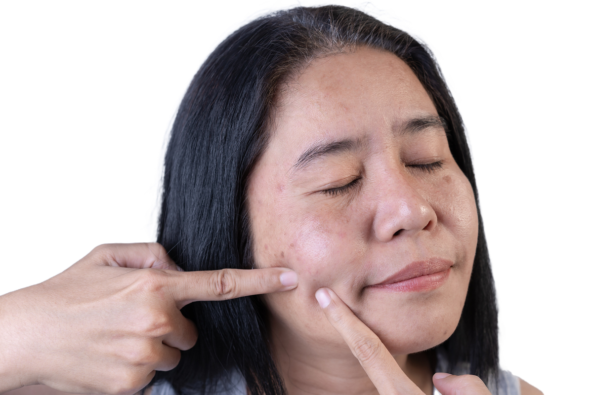 请模仿小红书博主的语气描述：用完5支传明酸精华之后皮肤有哪些变化