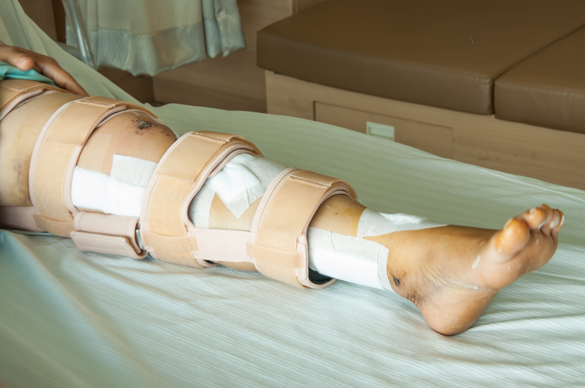 全身多发性骨折：原因、症状、治疗与康复