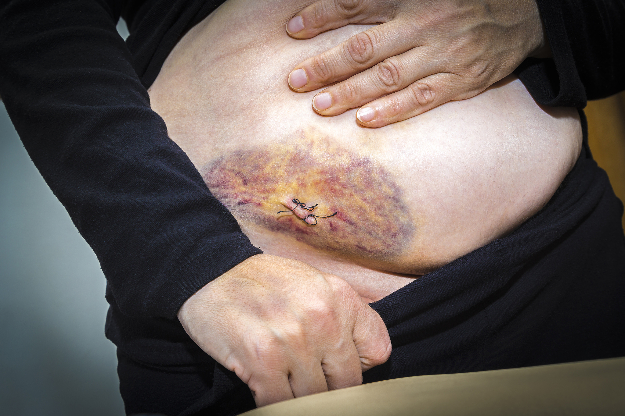 瘢痕子宫术后护理指南：切口、休息、心理和饮食全方位呵护