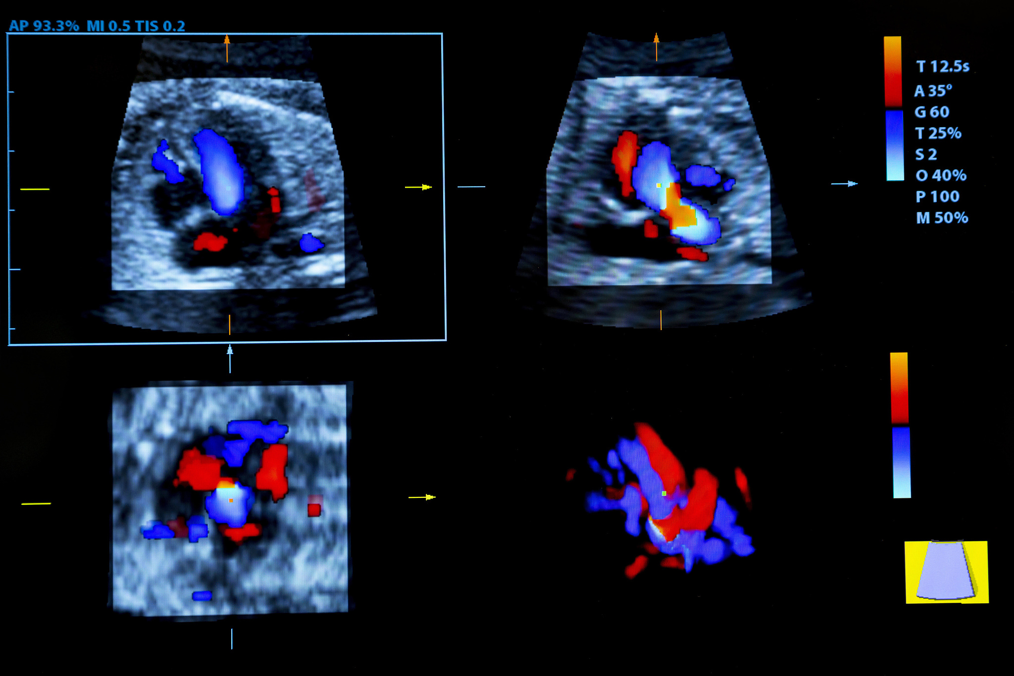 翻译：Consequently it is crucial to consider the potential of vulnerable carotid artery plaque rupture in acute stroke patients with contrast-enhanced ultrasound serving as a valuable diagnostic tool