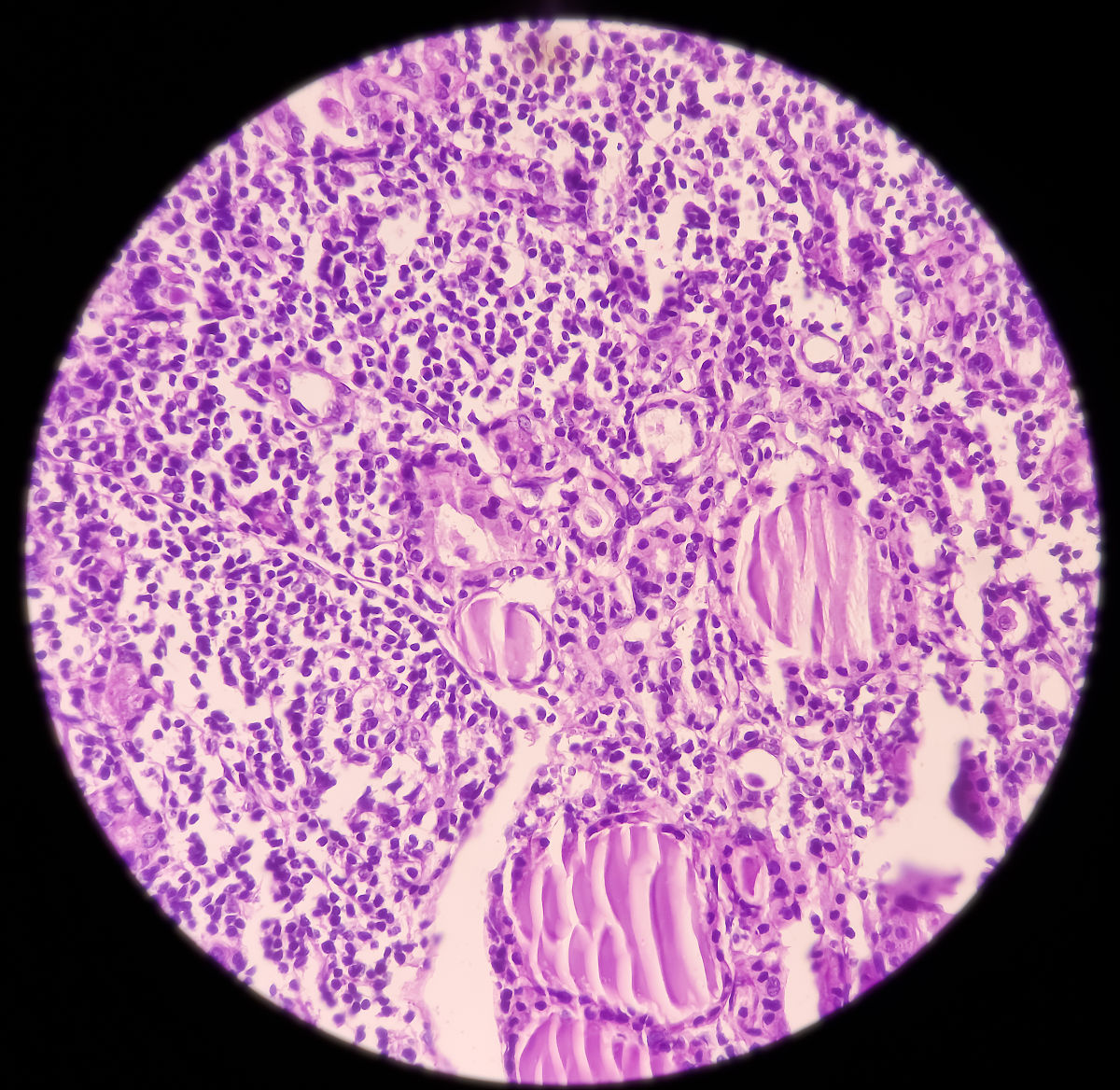 抗甲状腺过氧化物酶抗体的临床意义是什么？