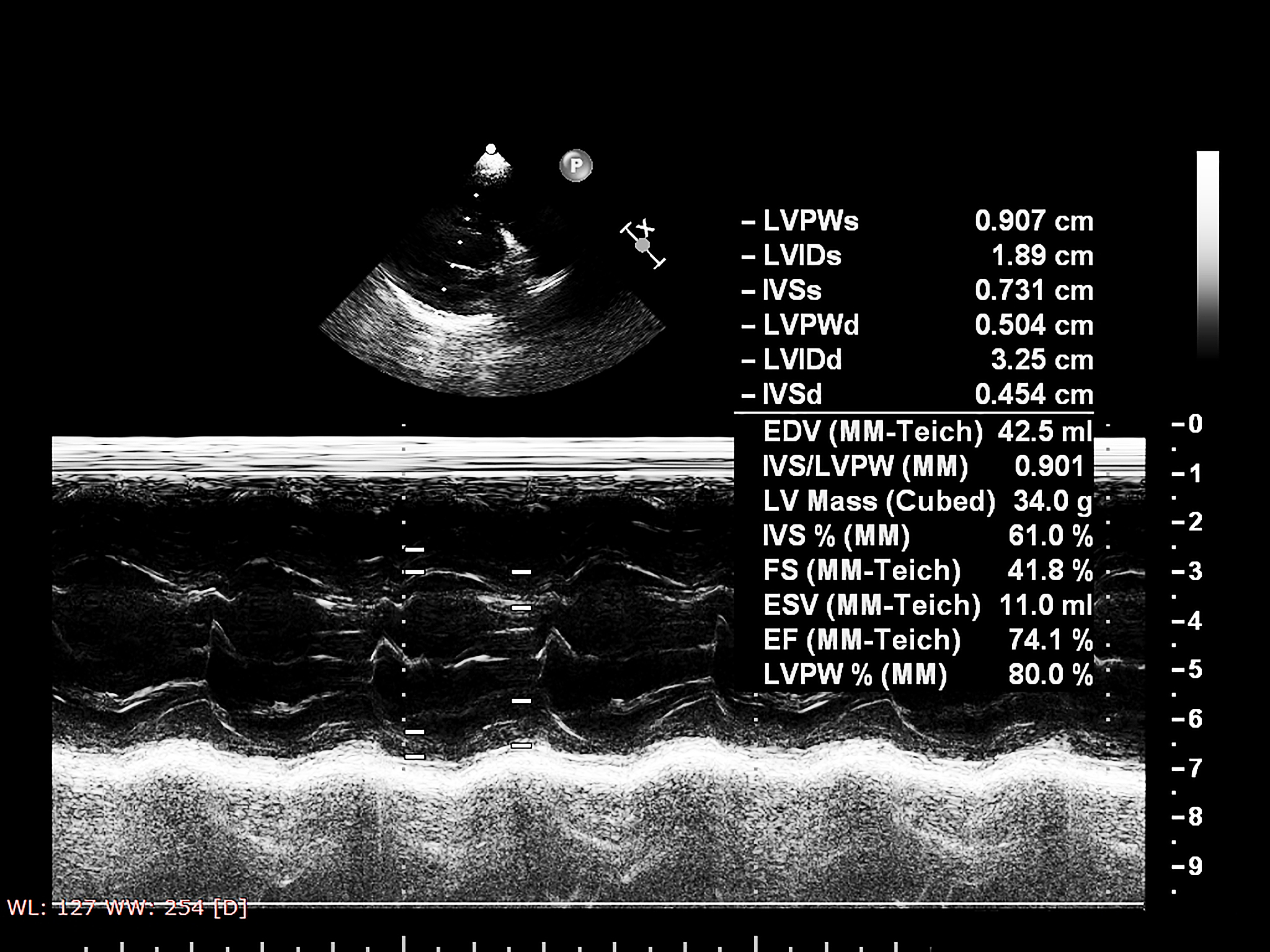 翻译：Additionally we noticed a suspicious area of very low echogenicity substance at the distal end of the plaque that showed slight oscillation with arterial pulsation