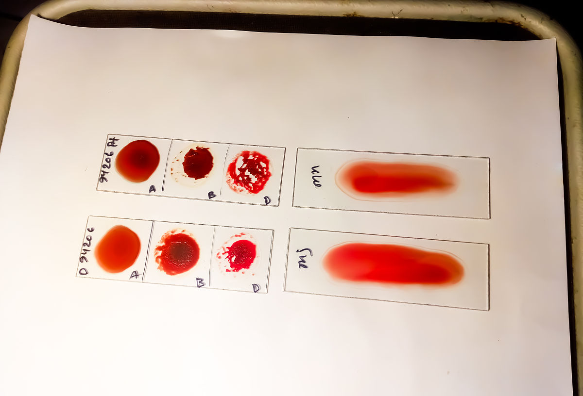 血凝试验：原理、步骤及临床意义