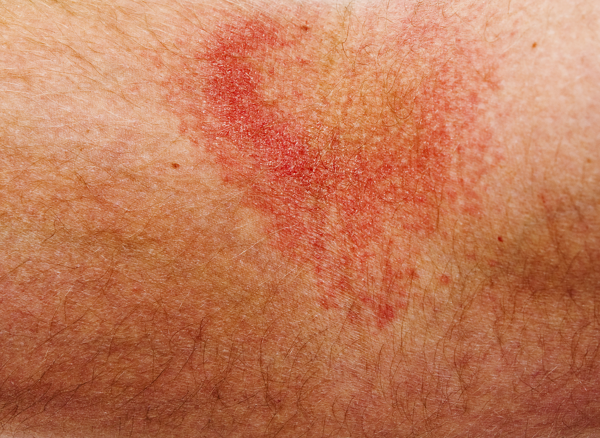 如何判断奶粉过敏