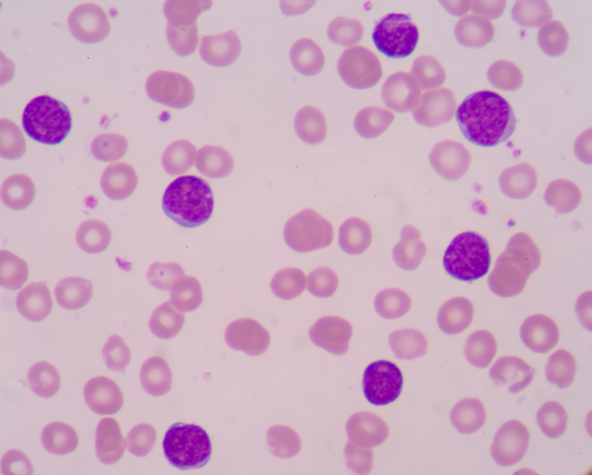 WBC 白细胞计数 1313 109L 35-95 WBC 白细胞计数 1313 109L 35-95