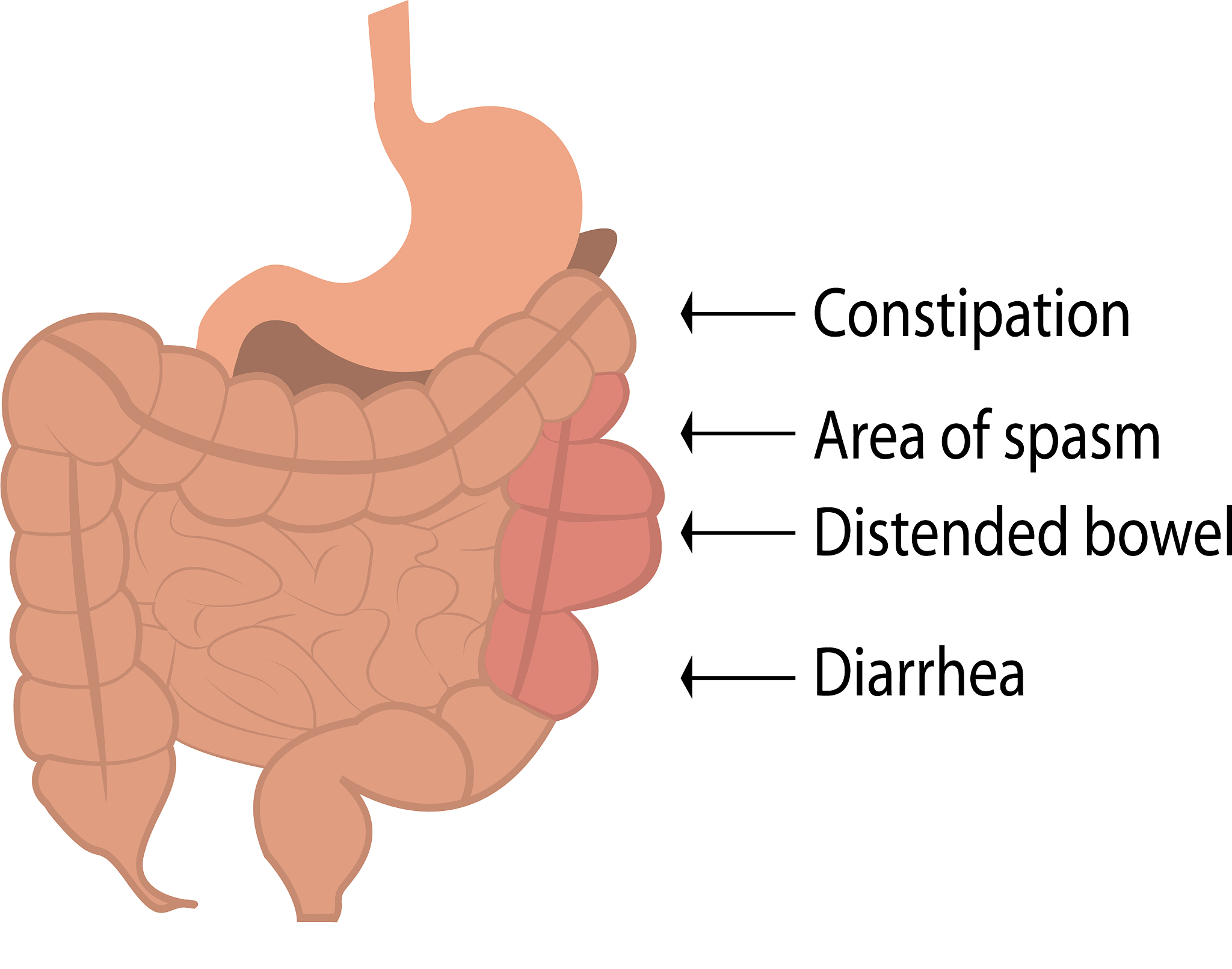 肠易激综合征（IBS）及其腹泻型亚型（IBS-D）：微生物-肠-脑轴的新视角