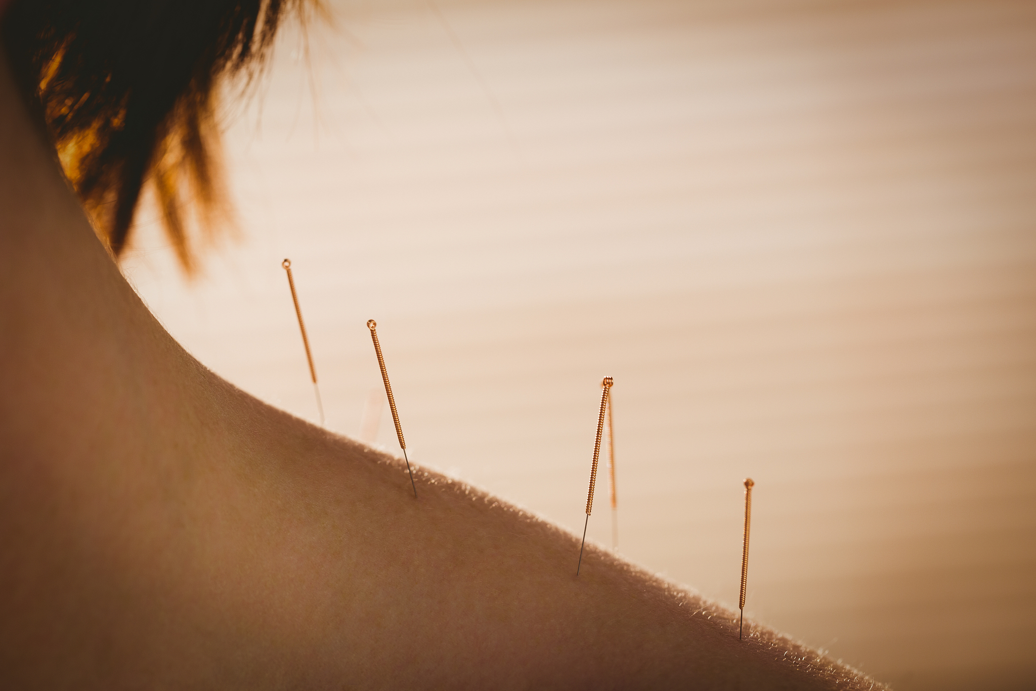 young woman getting acupuncture