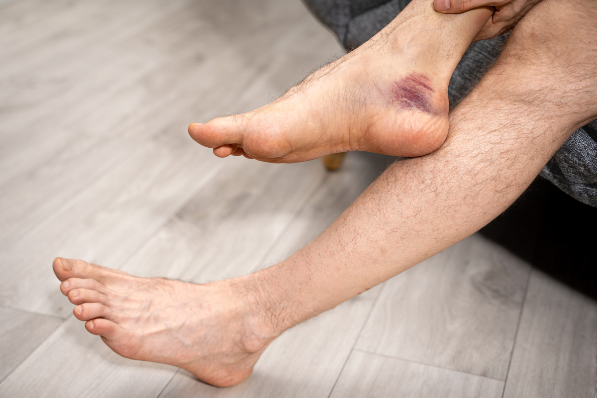 脚扭伤肿胀的原因：血管破坏、液体渗出和炎症反应