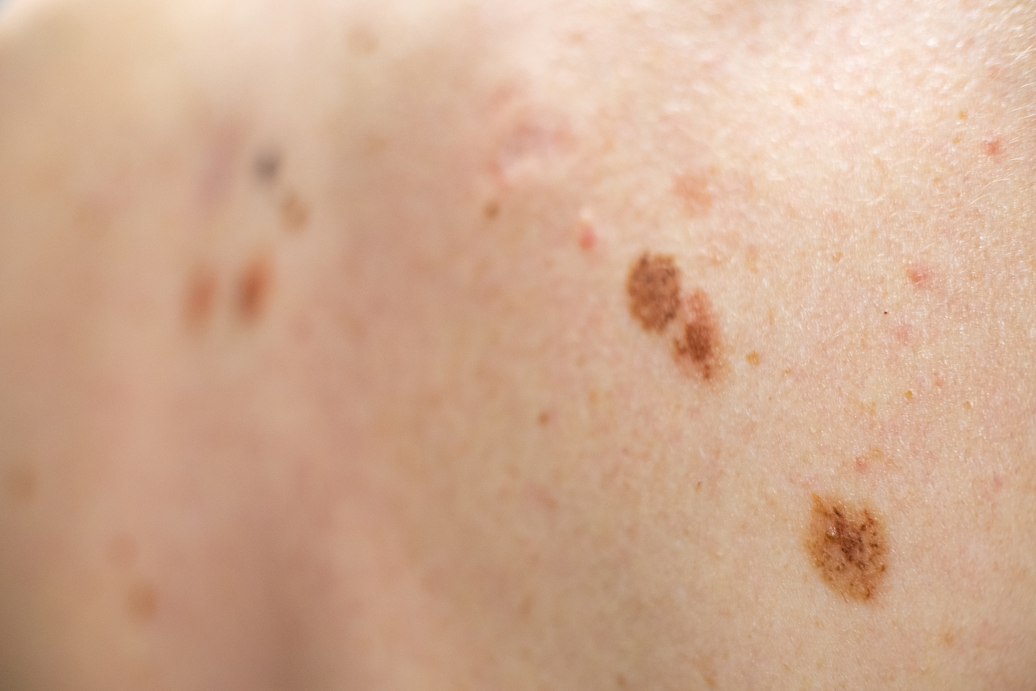melanocytic nevus, some of them dyplastic or atypical, on a cauc