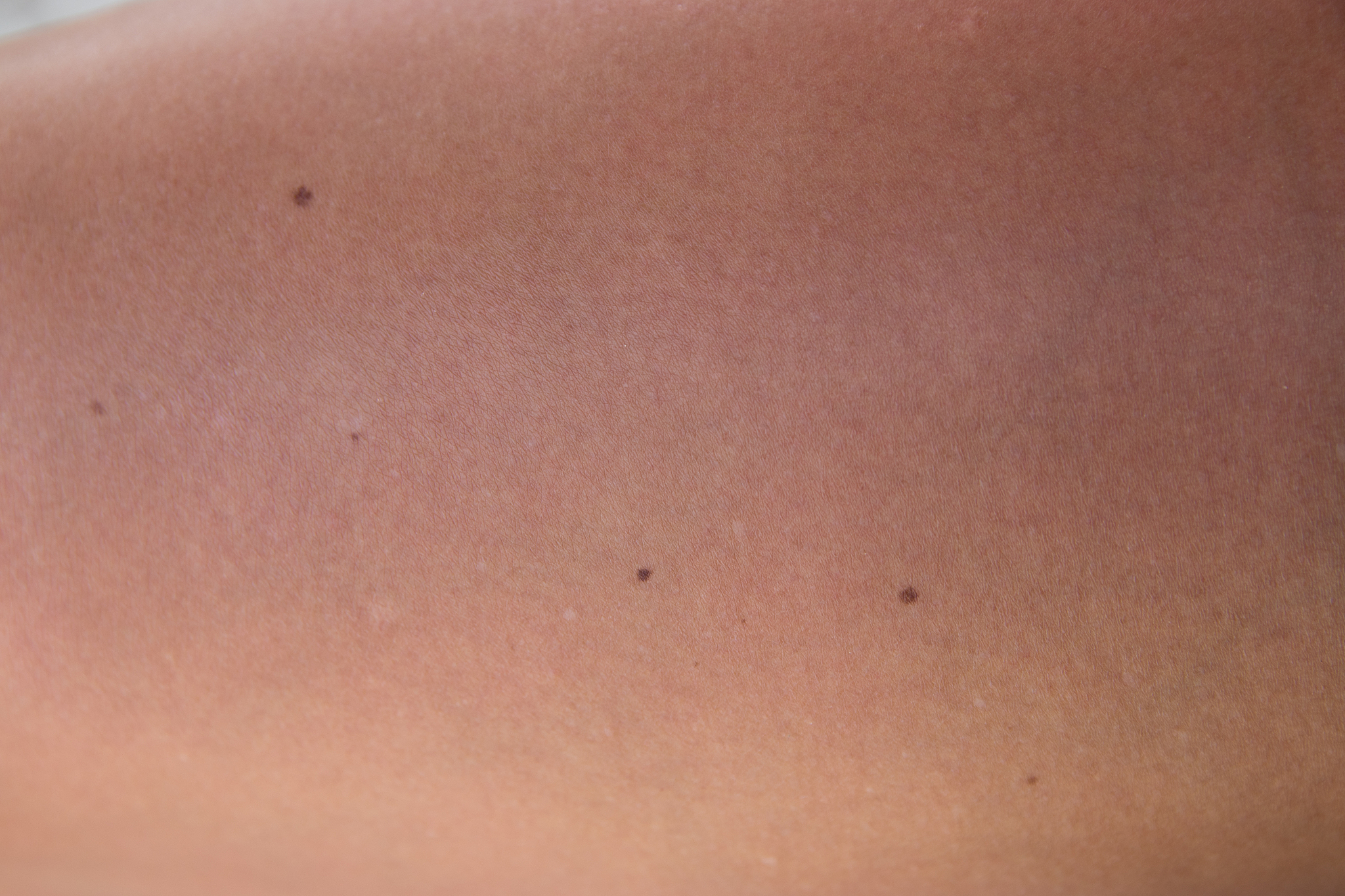 tanned skin with beauty marks