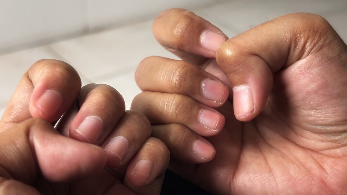 手指月牙突然消失？原因解析及应对措施 - 健康指南