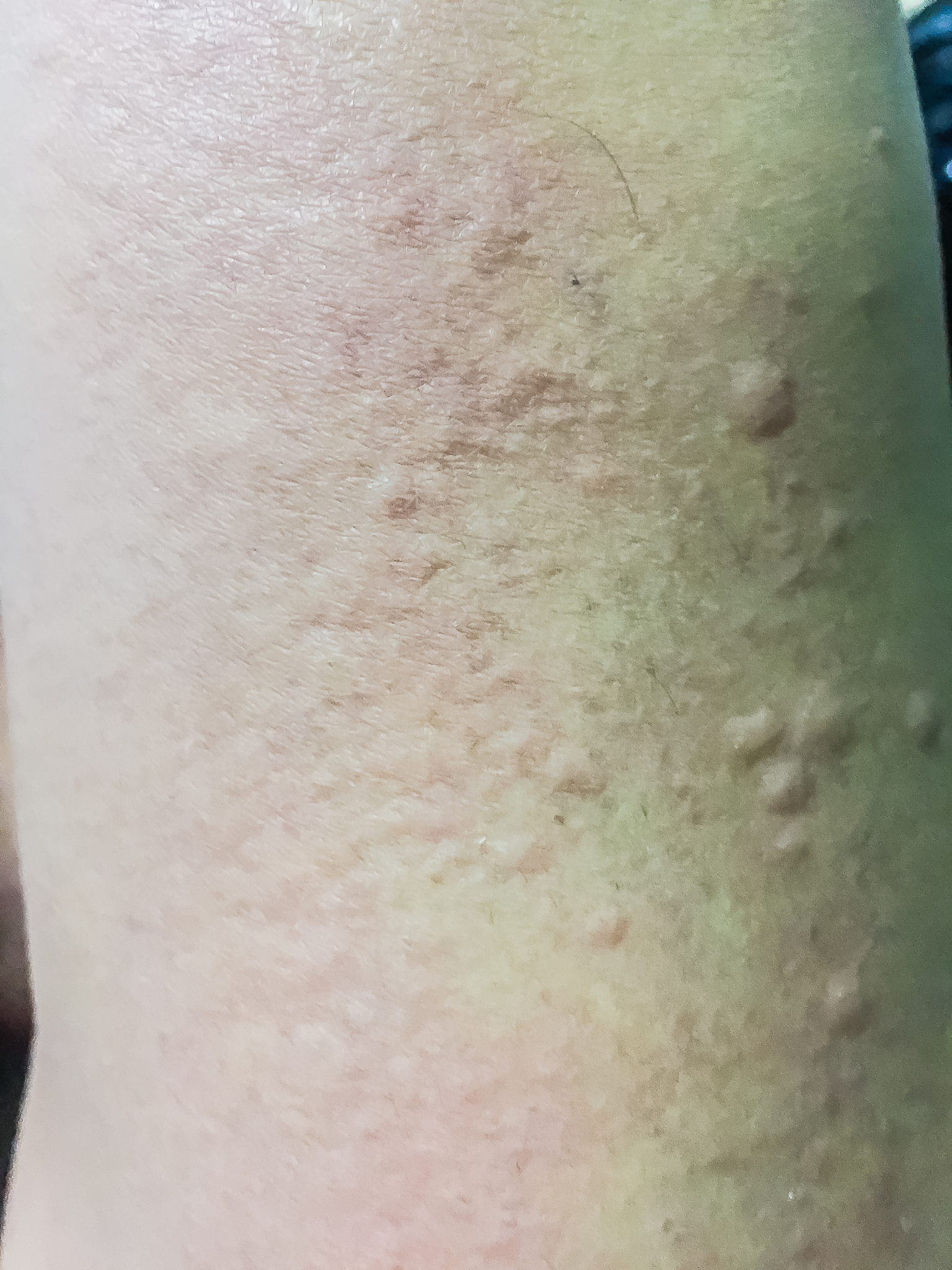 close up view of cold urticaria allergic rash. symptoms of itchy