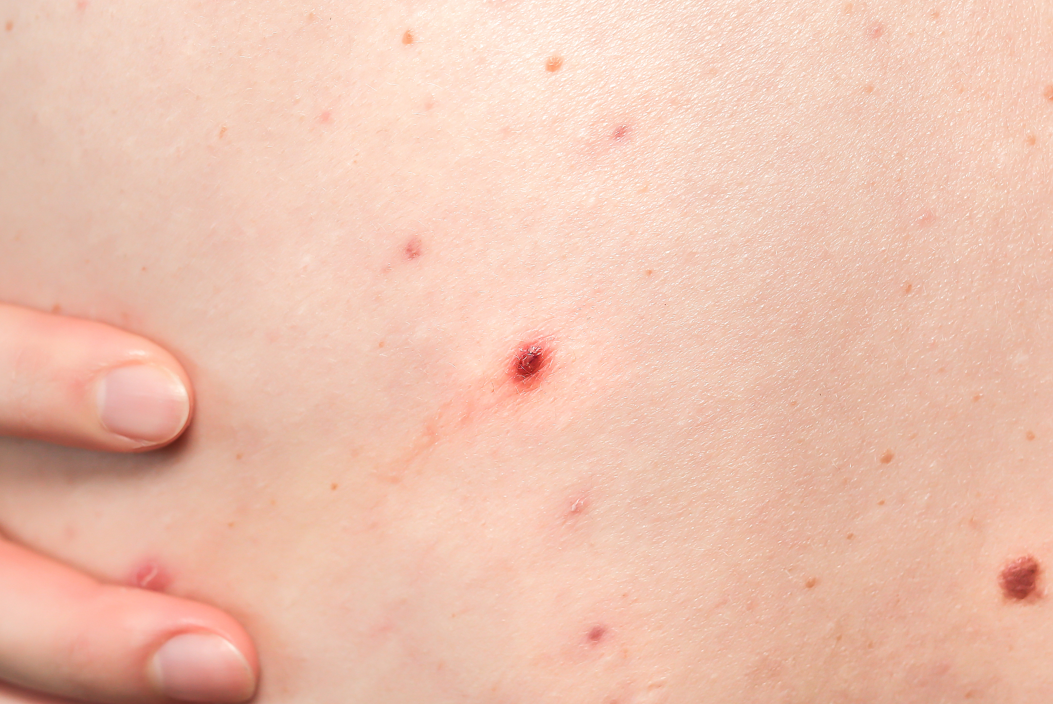 many birthmarks on the girl's back. medical health photo. woman'
