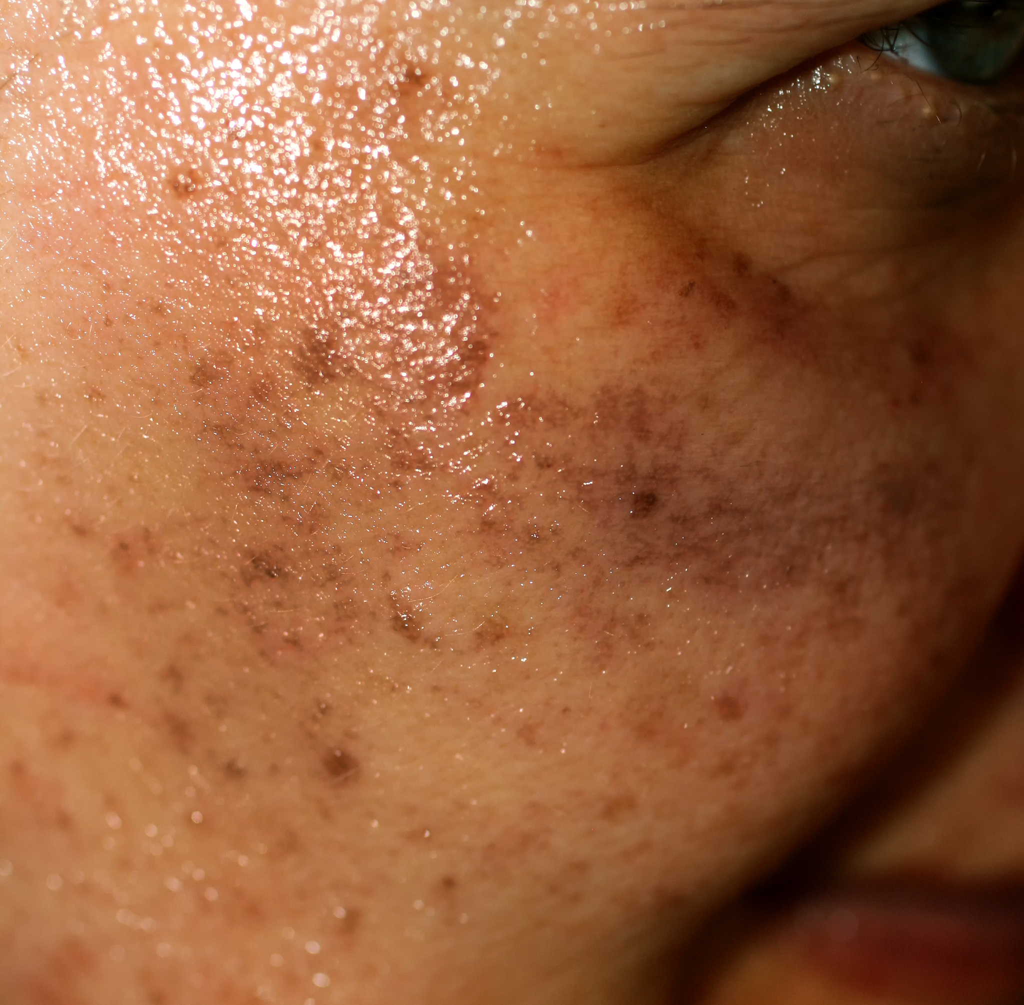 pigmented spots on the face. pigmentation on cheeks